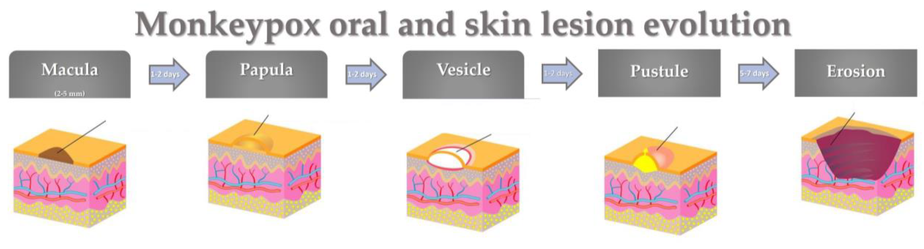 Update on Monkeypox - Dimensions of Dental Hygiene