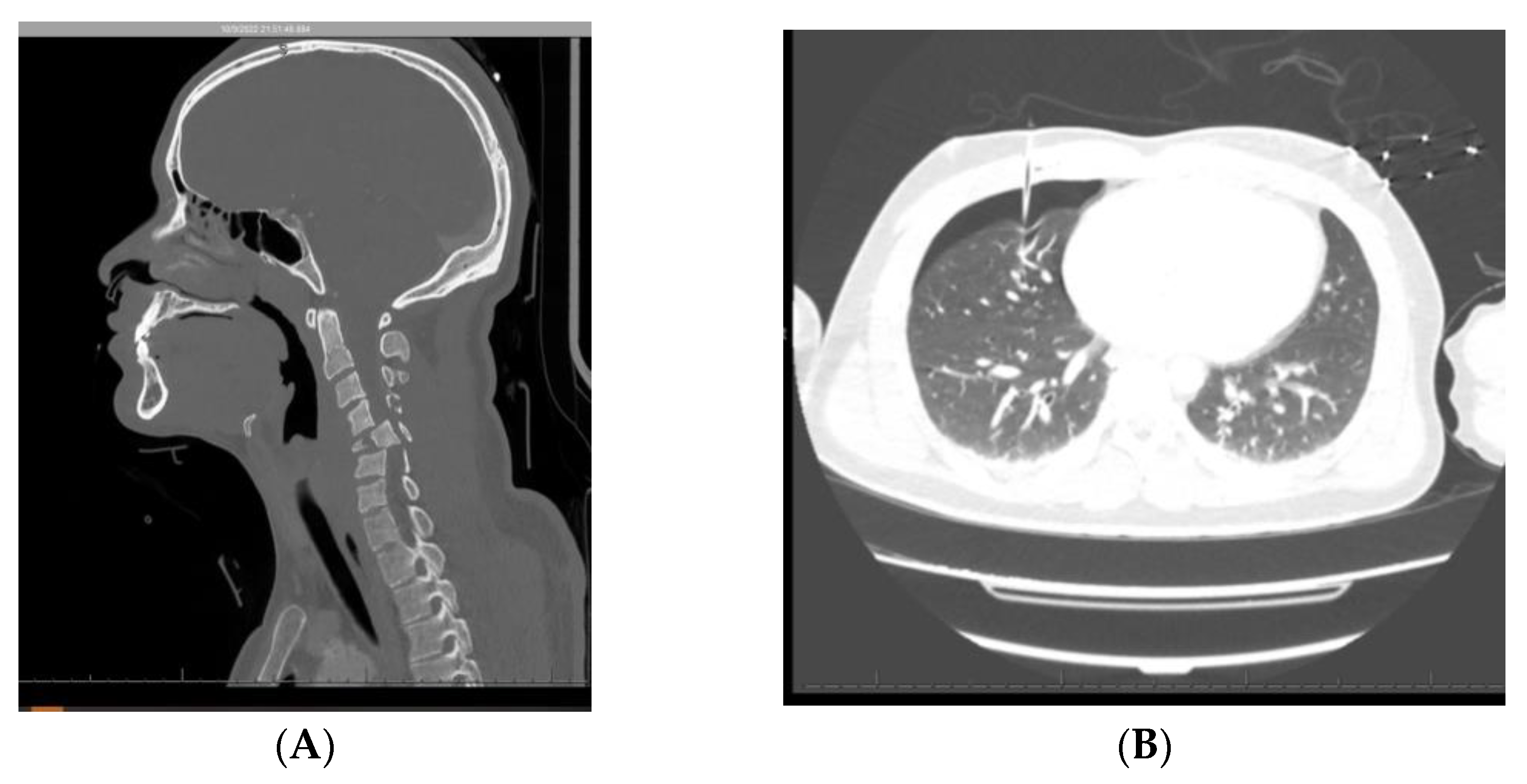 Complications of Spinal Cord Stimulator