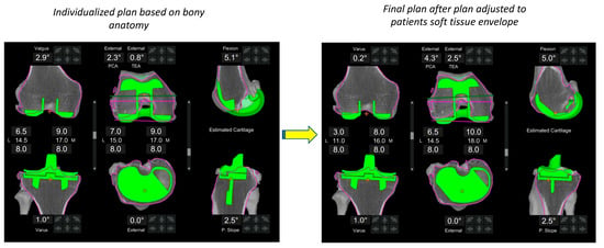 How does the use of quantified gap-balancing affect component positioning  and limb alignment in robotic total knee arthroplasty using functional  alignment philosophy? A comparison of two robotic platforms