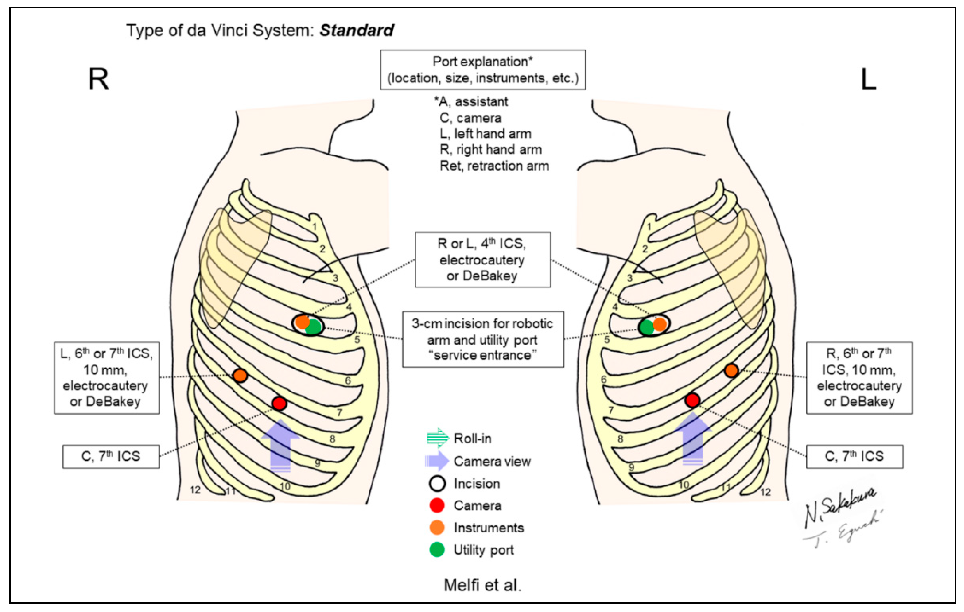 JPM | Free Full-Text | Port Placement Variations for Robotic Lung ...