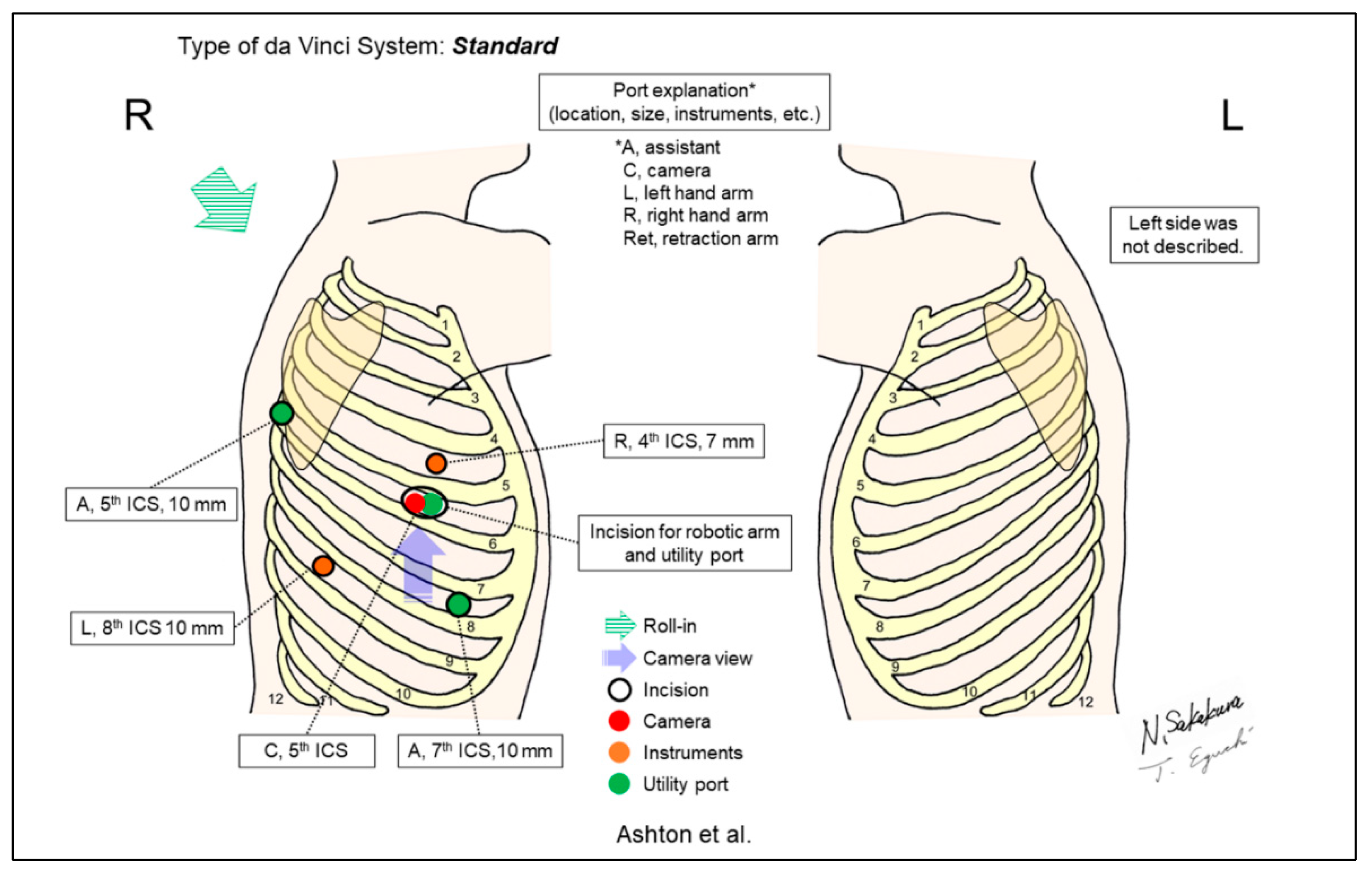 JPM | Free Full-Text | Port Placement Variations for Robotic Lung ...