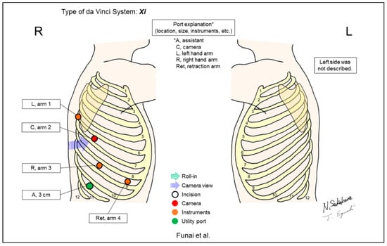 Port placement. A Schematic illustrations of port placement of the