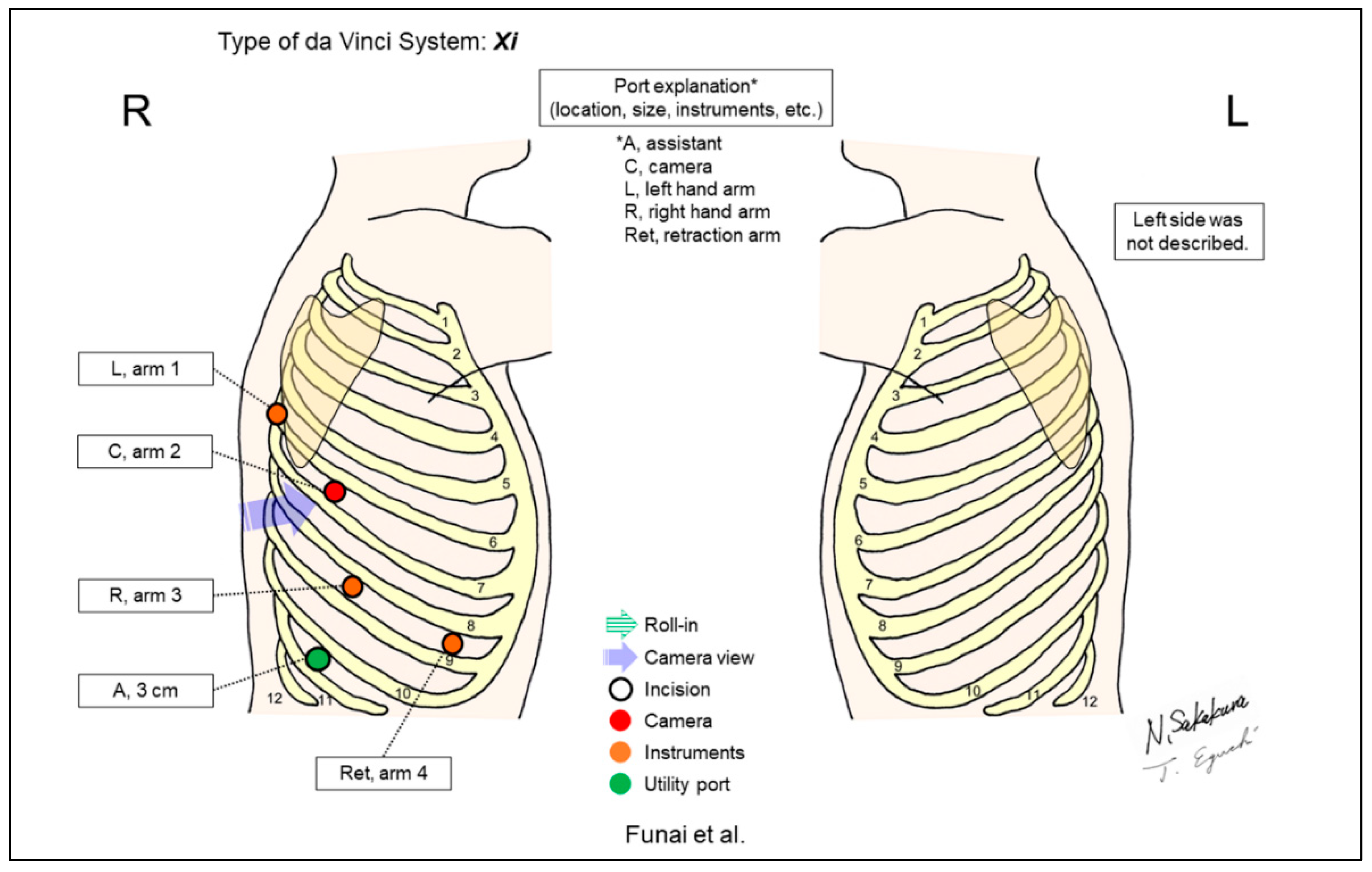 JPM | Free Full-Text | Port Placement Variations for Robotic Lung ...