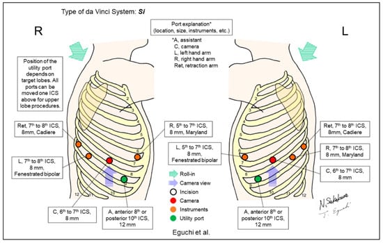 JPM | Free Full-Text | Port Placement Variations for Robotic Lung ...