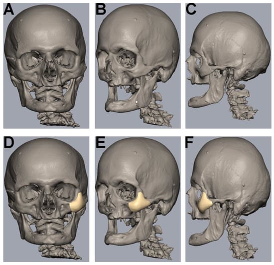 JPM | Free Full-Text | Metallic Artifact Reduction in Midfacial CT