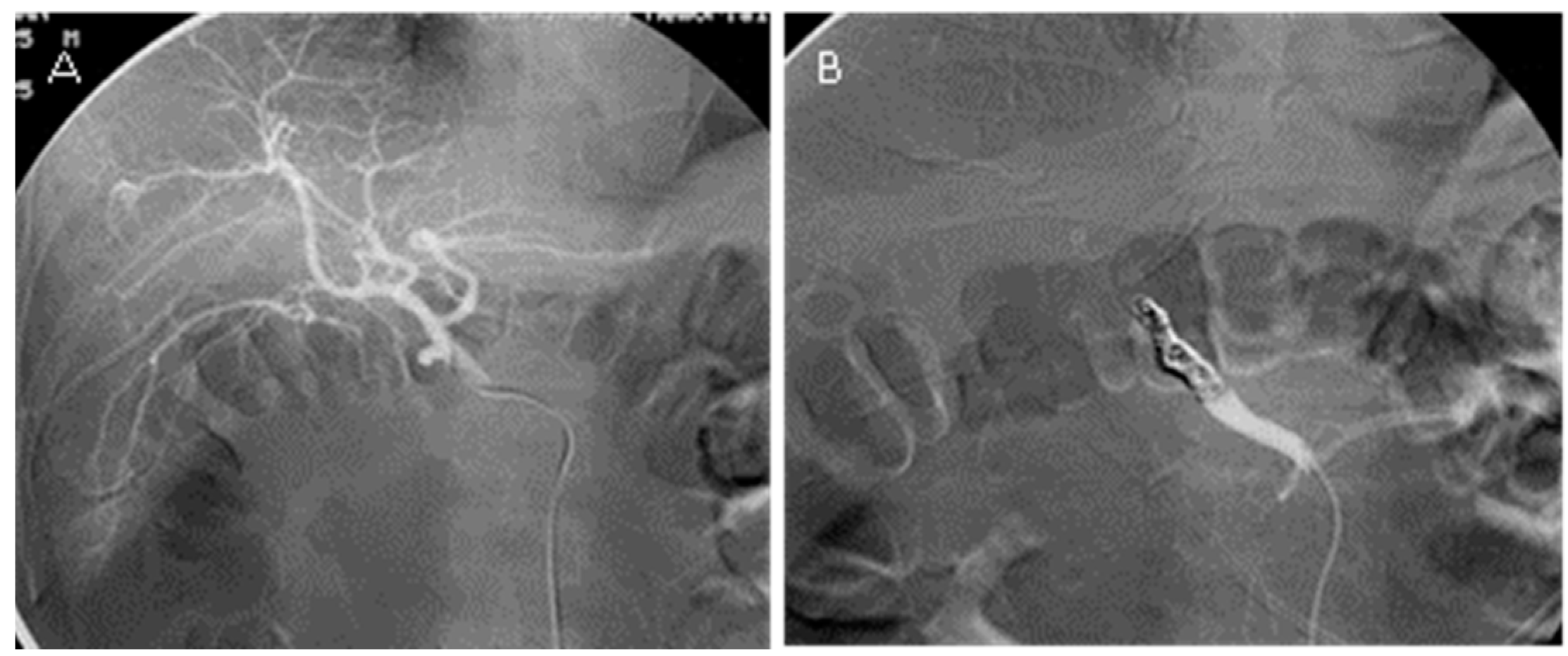 Comparing the Clinical Efficacy of Coil Embolization in GDA Stump ...