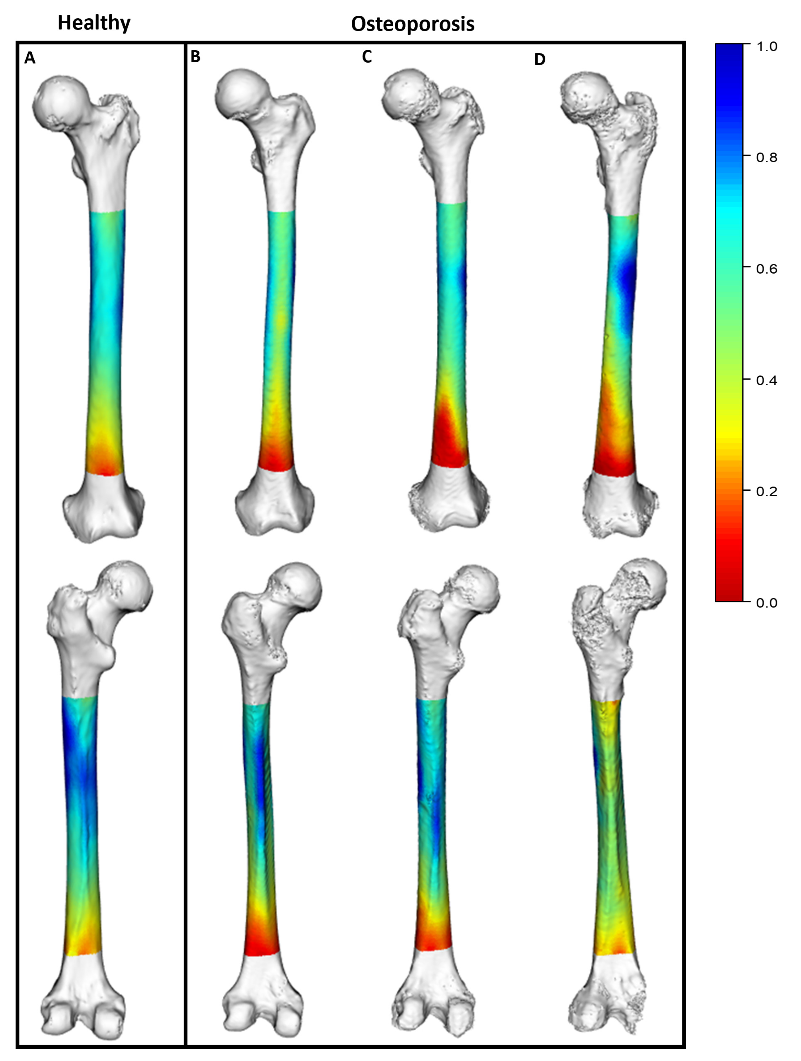 JPM | Free Full-Text | Advancing Osteoporosis Evaluation Procedures:  Detailed Computational Analysis of Regional Structural Vulnerabilities in  Osteoporotic Bone