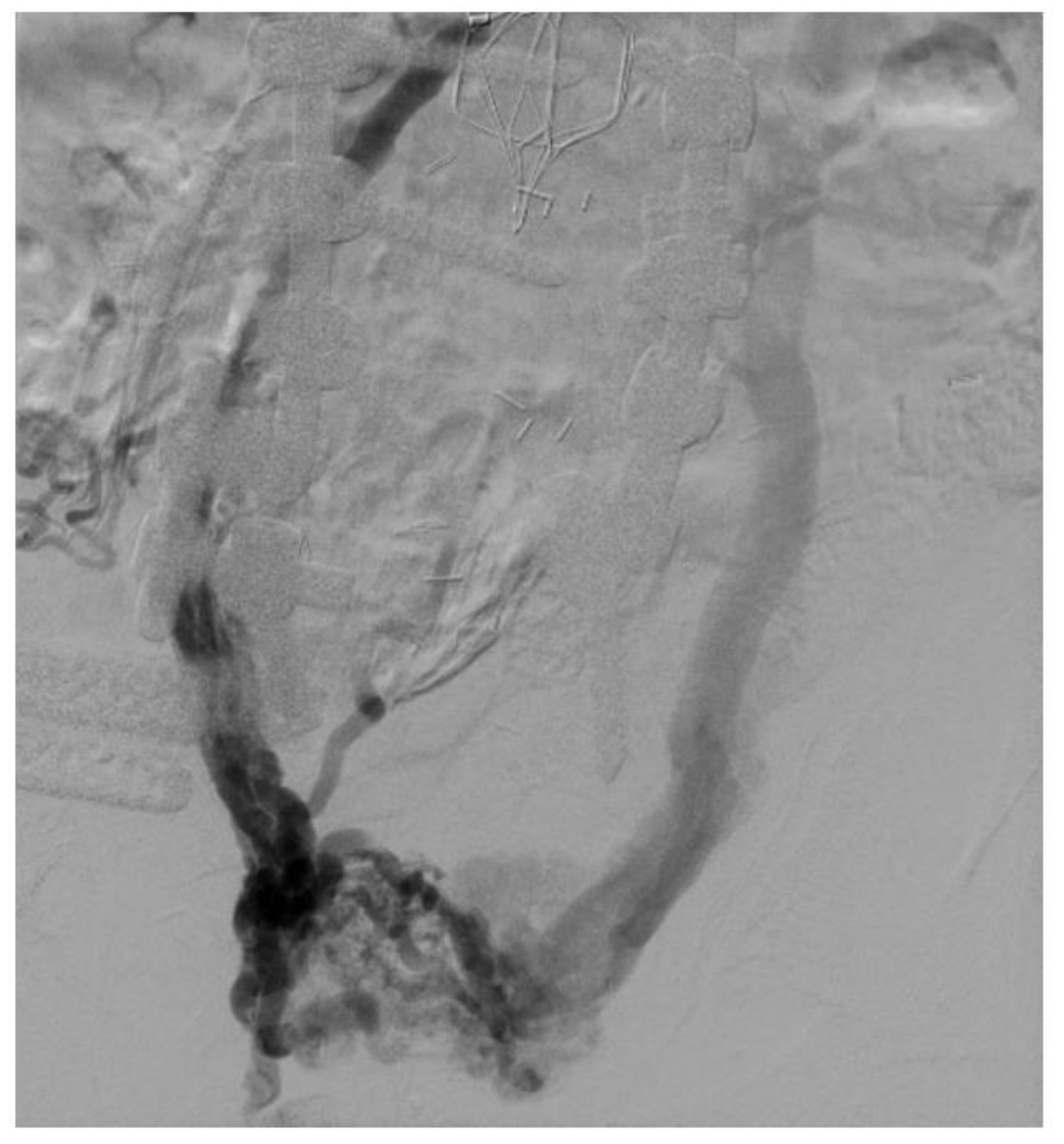 The biomechanical impact of hip movement on iliofemoral venous anatomy and  stenting for deep venous thrombosis - ScienceDirect