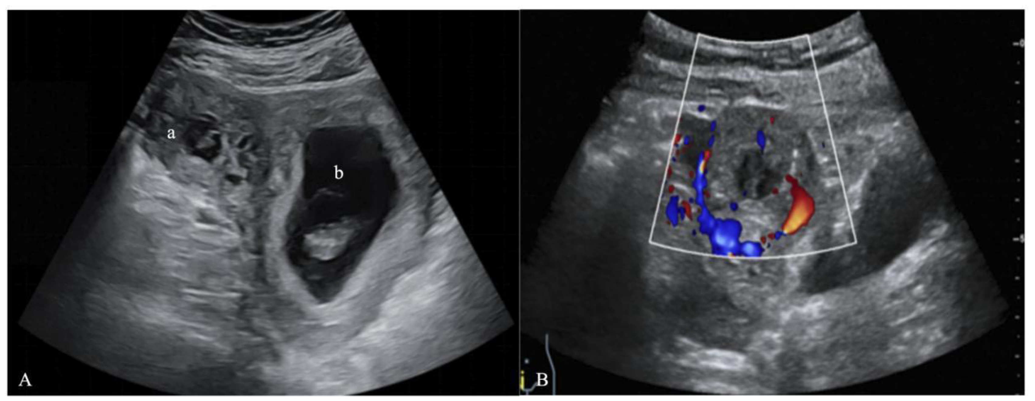 Successful Ultrasound Guided Methotrexate Intervention In The Treatment 