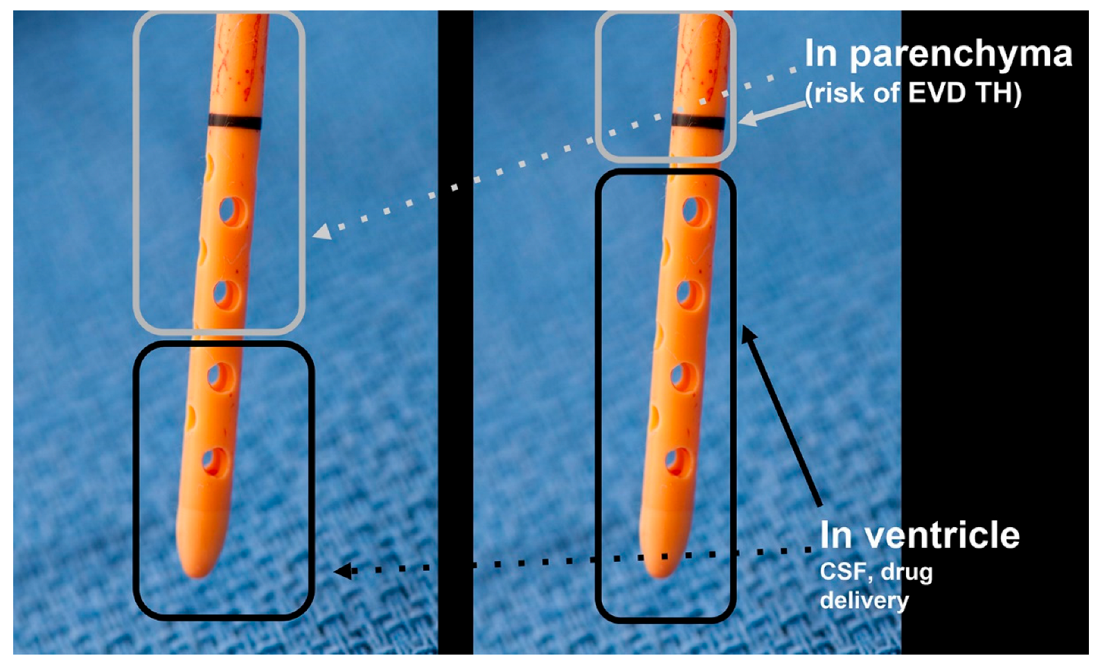 injection intraventriculaire