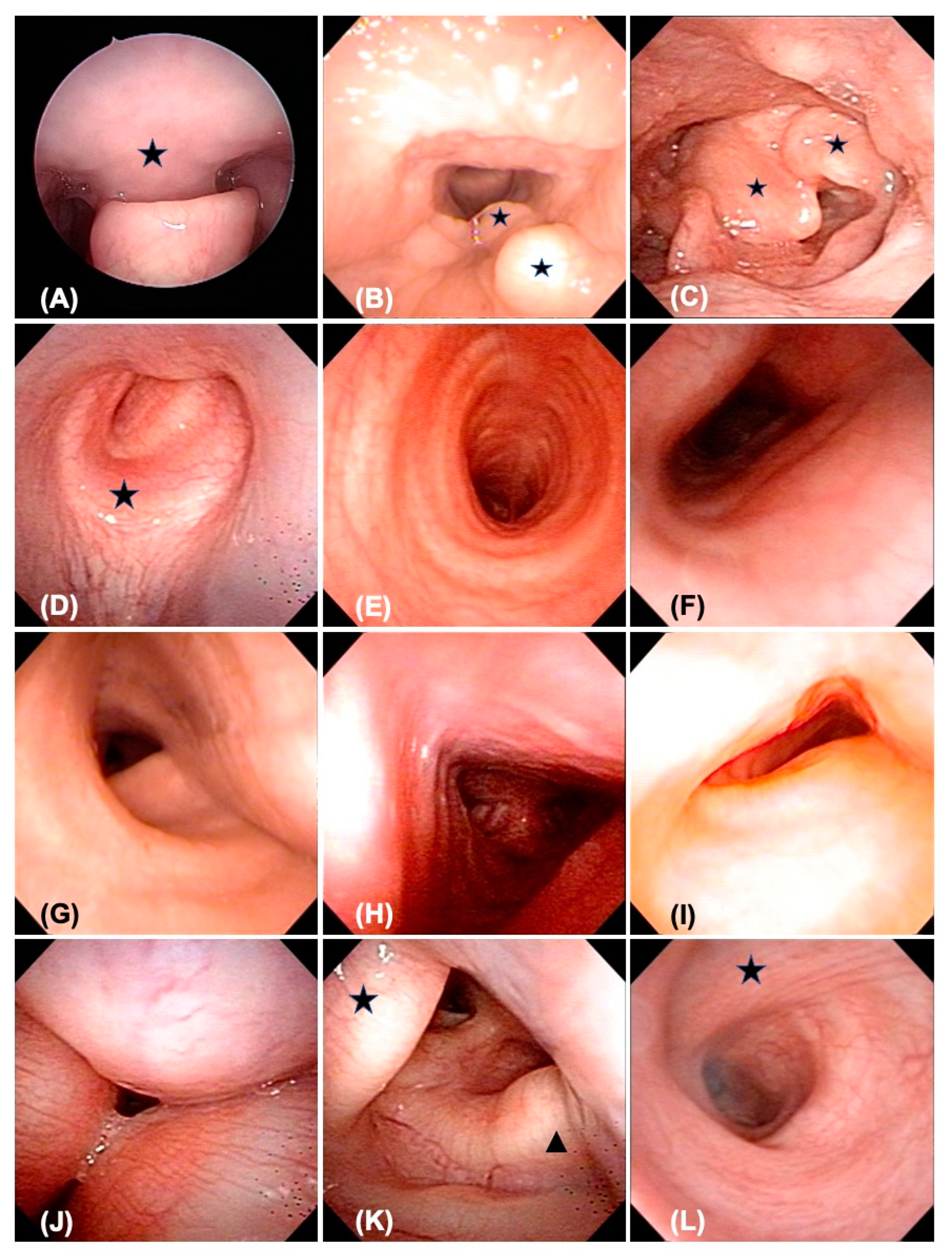 JPM | Free Full-Text | Endoscopic and Image Analysis of the Airway in  Patients with Mucopolysaccharidosis Type IVA