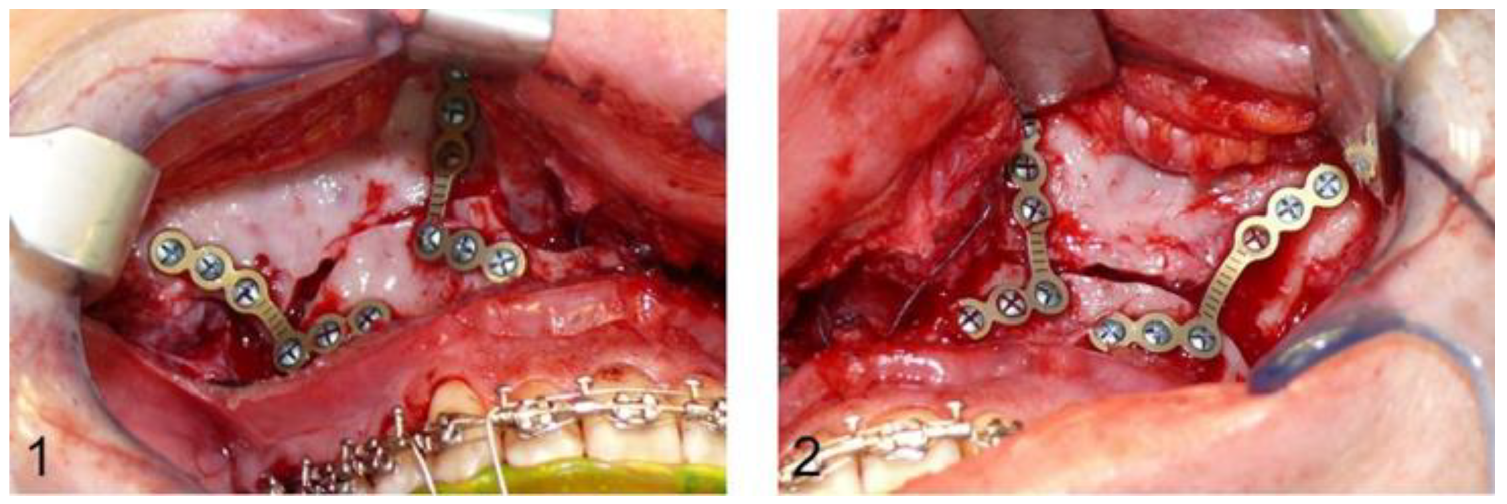 JPM | Free Full-Text | Dental Root Injuries Caused by Osteosynthesis Screws  in Orthognathic Surgery&mdash;Comparison of Conventional Osteosynthesis and  Osteosynthesis by CAD/CAM Drill Guides and Patient-Specific Implants