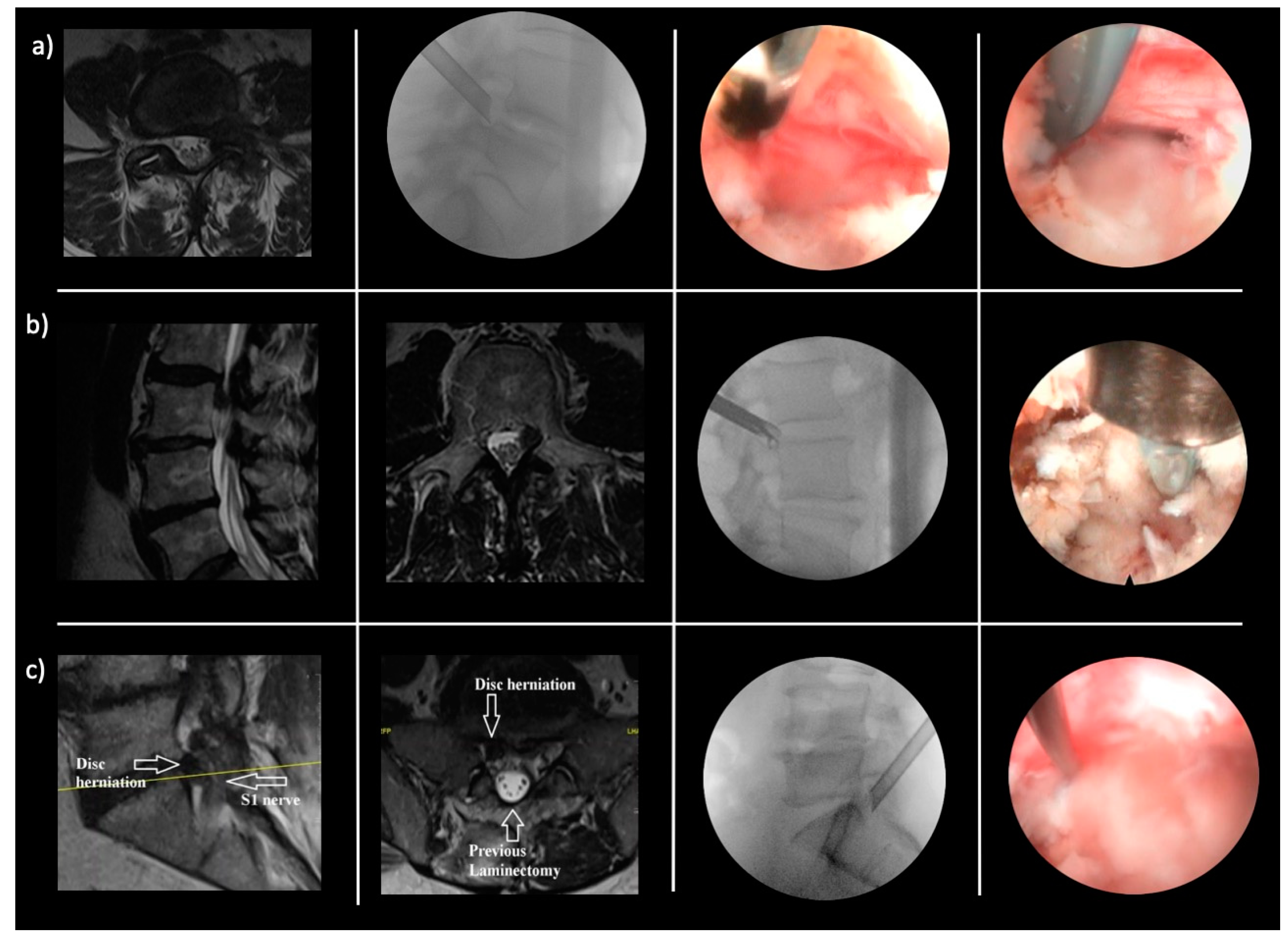 Will My Herniated Disc Heal on Its Own?: Atlas Neurosurgery and Spine  Center: Neurosurgery