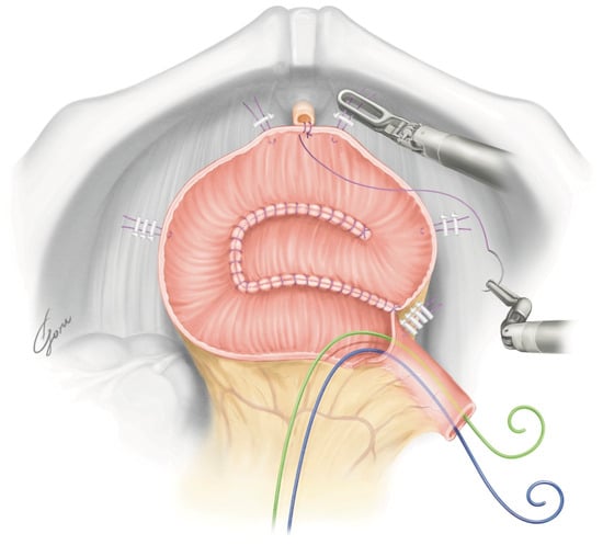 JPM | Free Full-Text | Robot-Assisted Radical Cystectomy with Modified ...