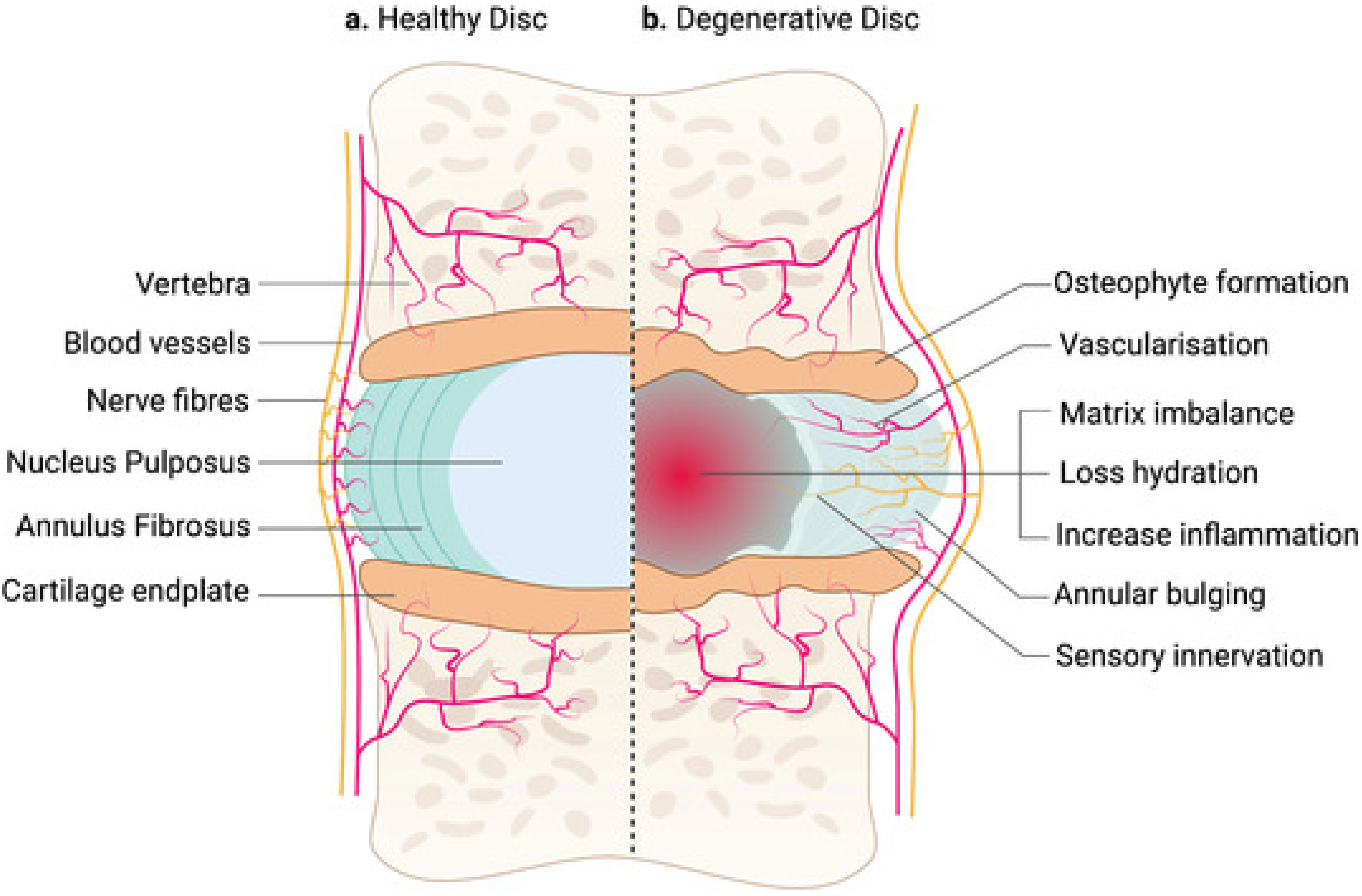 discogenic back pain literature review of definition diagnosis and treatment