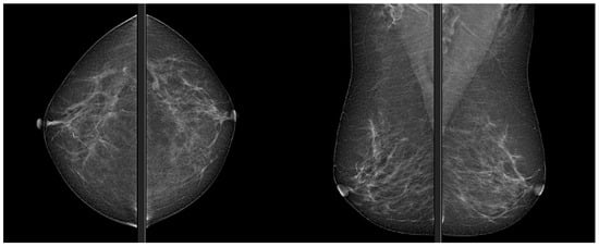 JPM | Free Full-Text | Radiomics in Breast Imaging: Future Development