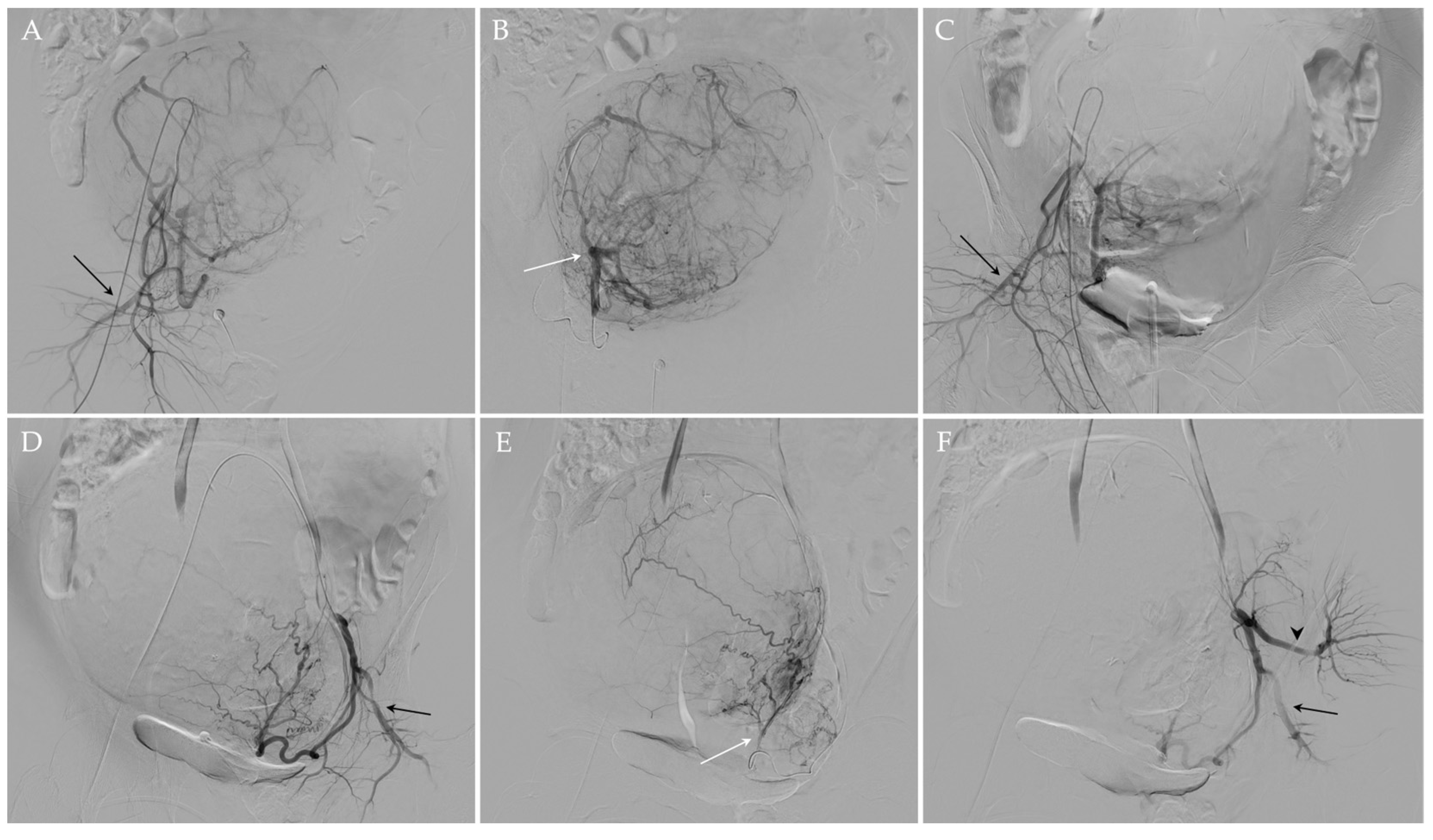 Jpm Free Full Text Uterine Artery Embolization For The Treatment Of