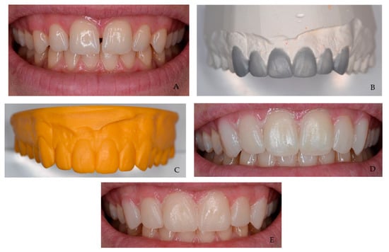a-d, Silicone indexes from wax-up. Incisal(e) and facial(f) views