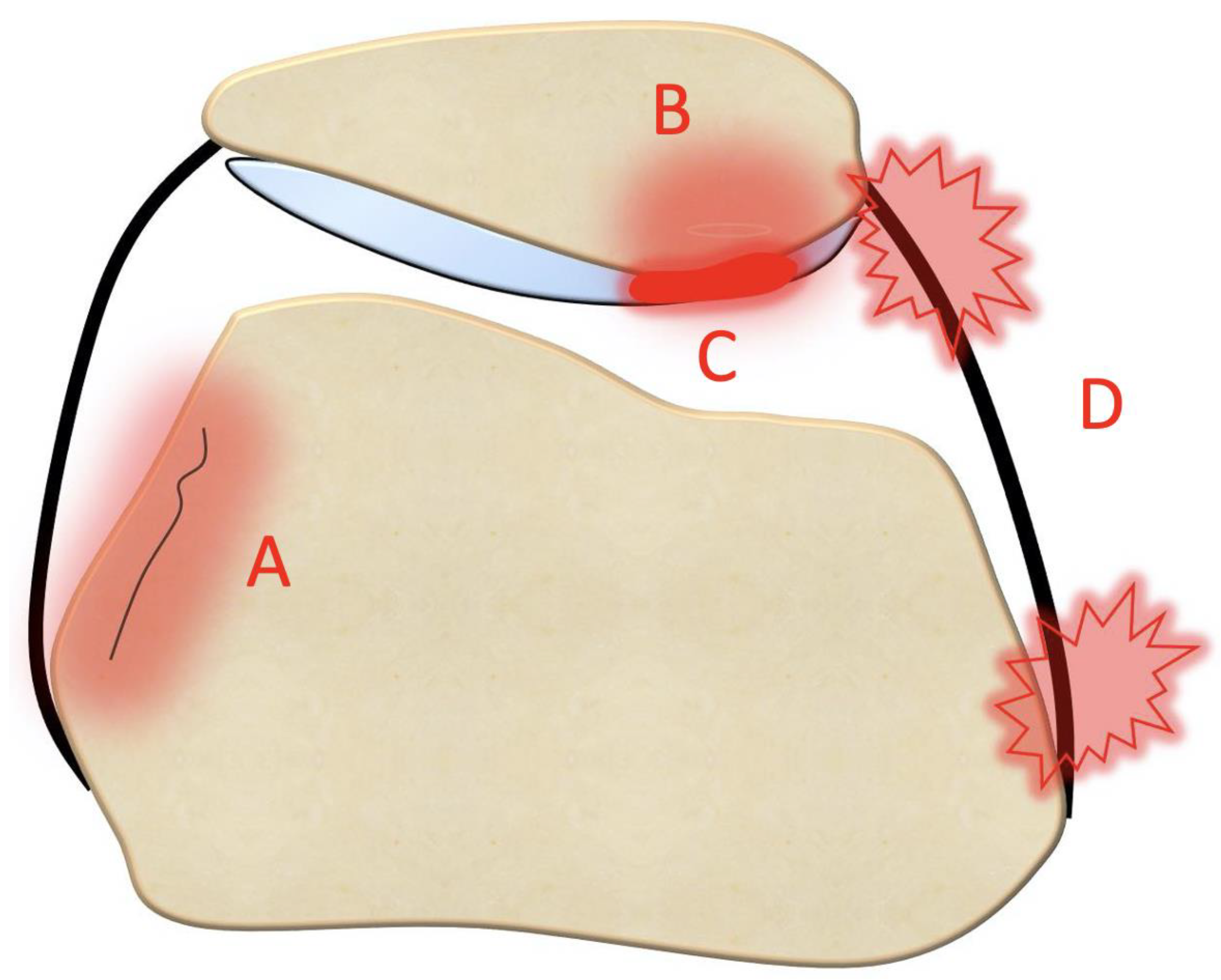 Patellar instability can be classified into four types based on patellar  movement with knee flexion: a three-dimensional computer model analysis -  ScienceDirect