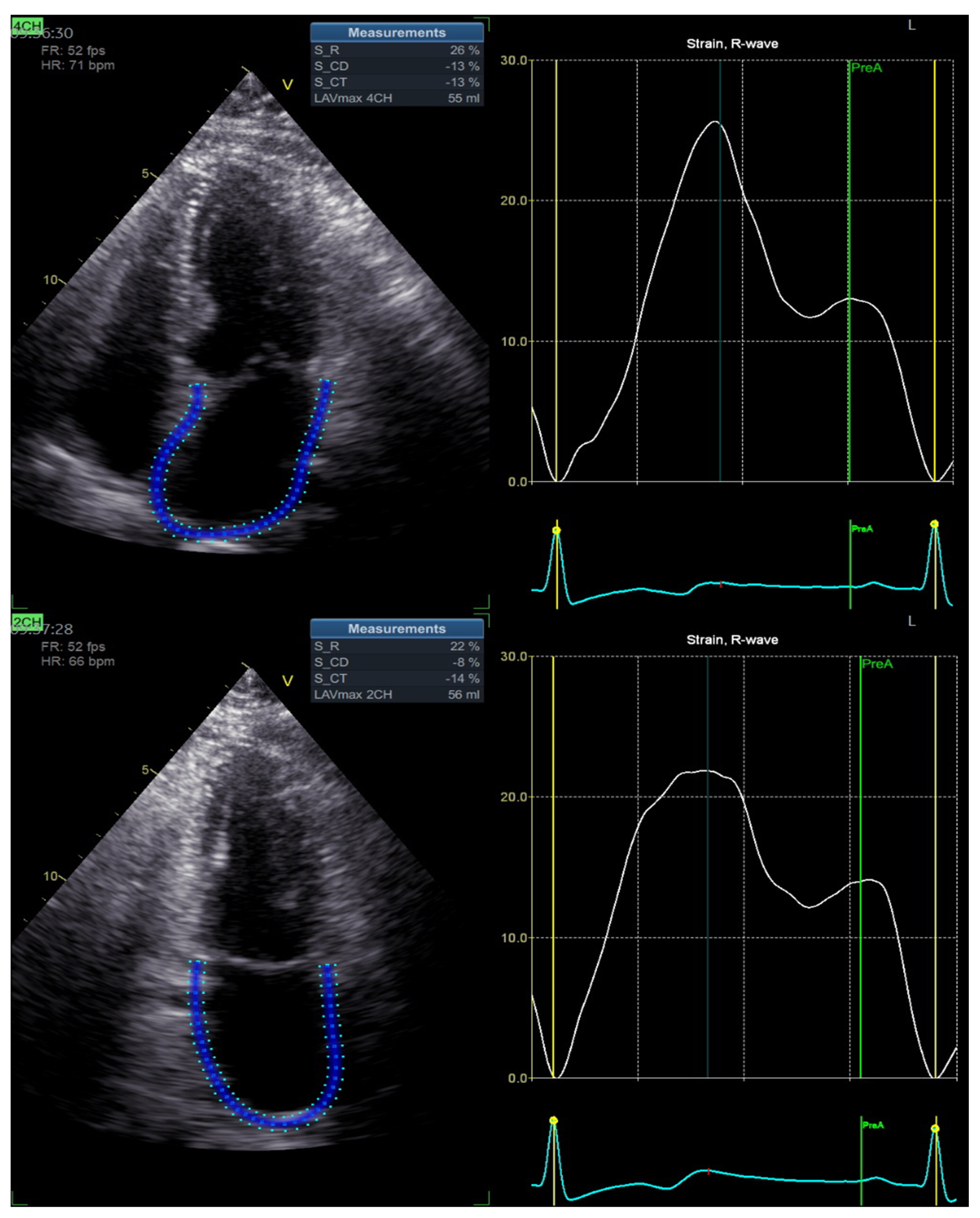 Left Atrial Strain Determinants During the Cardiac Phases