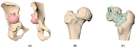 Anatomy, Pathology & Treatment of the Hip joint - Articles & Advice