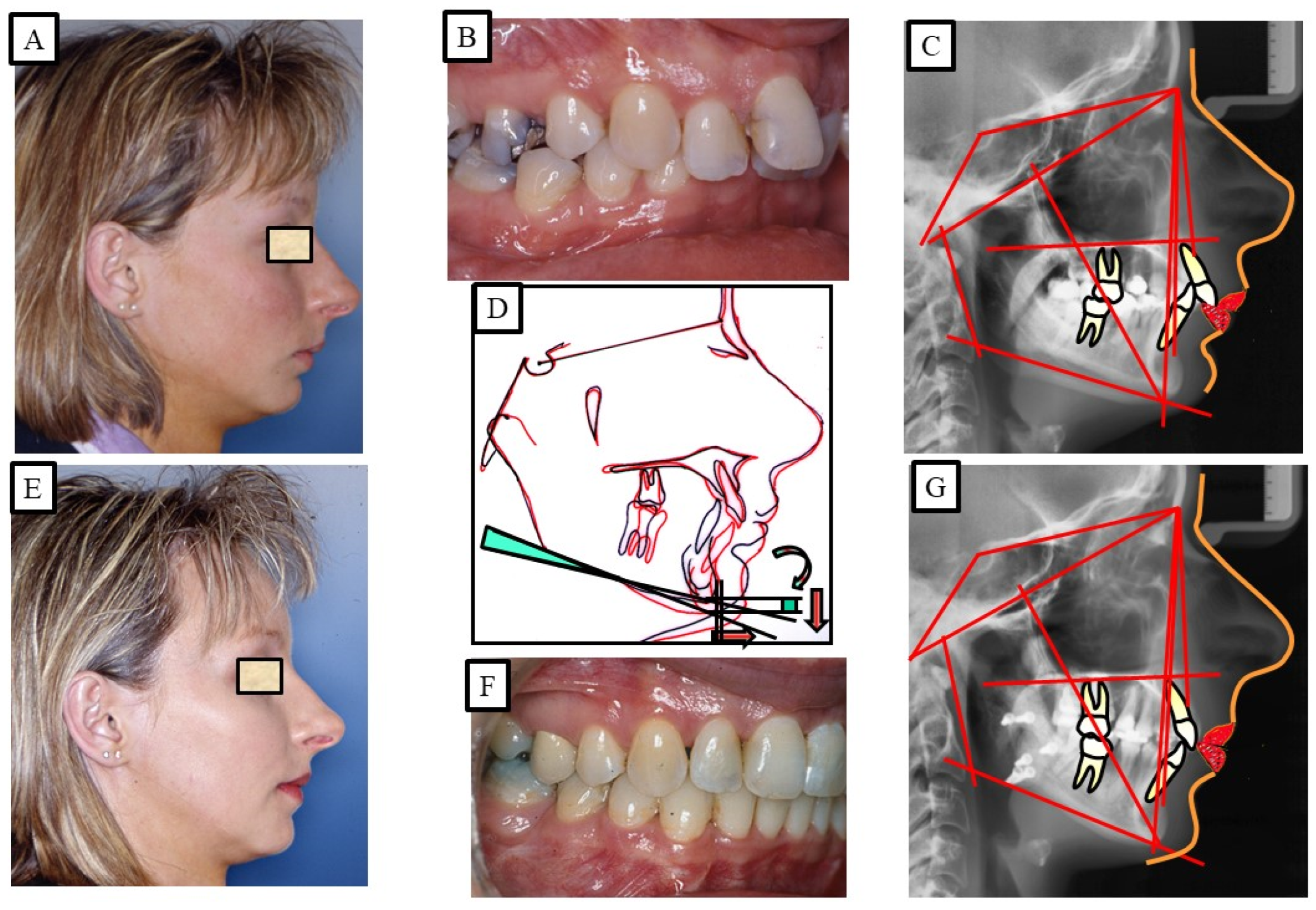 Adult patient with Class II, Div. 2 malocclusion and collapse of