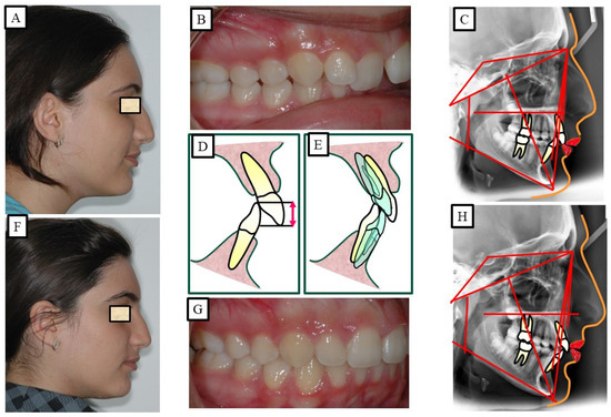 17-year-old female with Class II malocclusion and traumatic deepbite