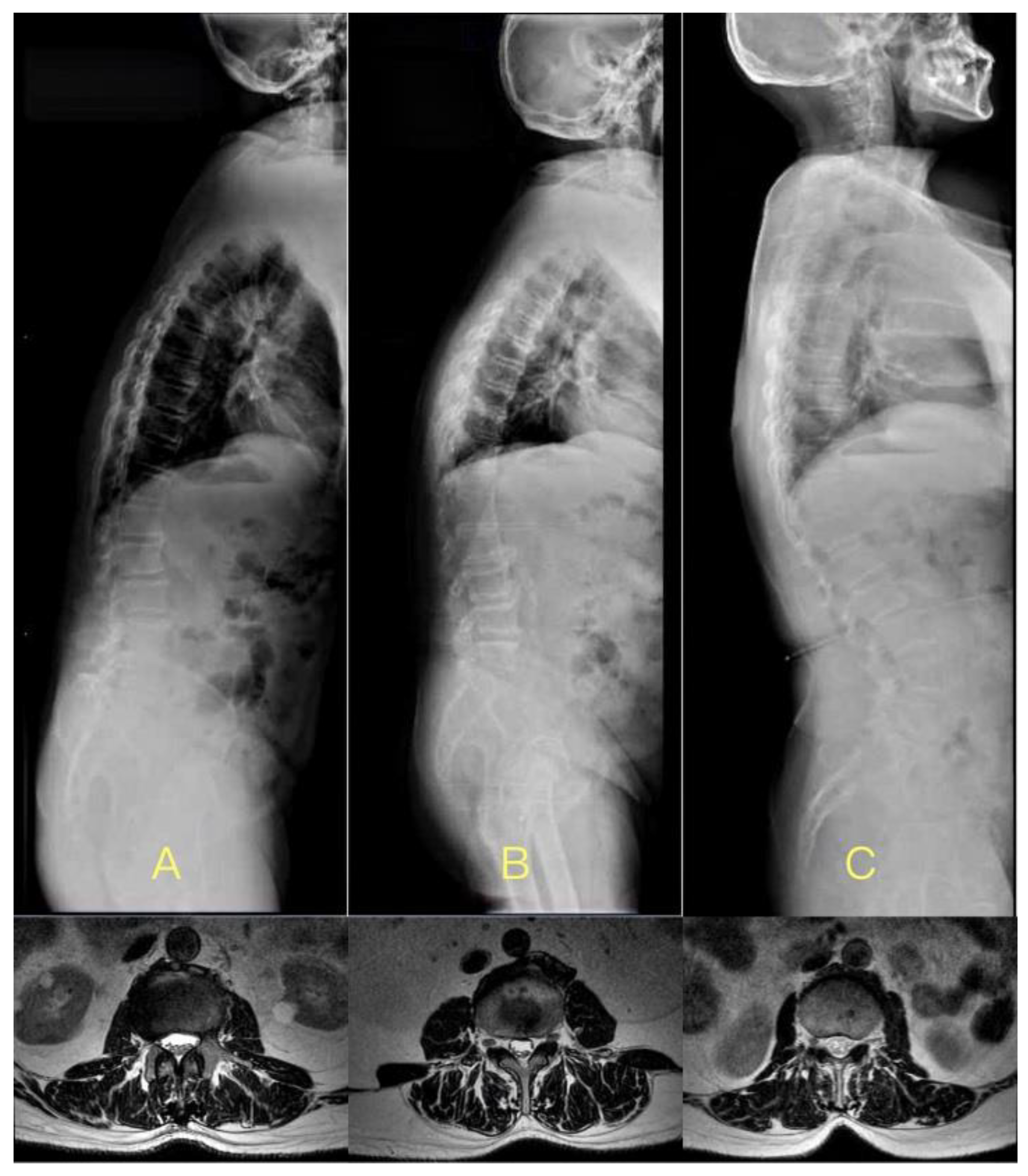 The correlation between vertebral wedge-shaped changes in X-ray imaging at  supine and standing positions and the efficacy of operative treatment of  thoracolumbar spinal fracture in the elderly