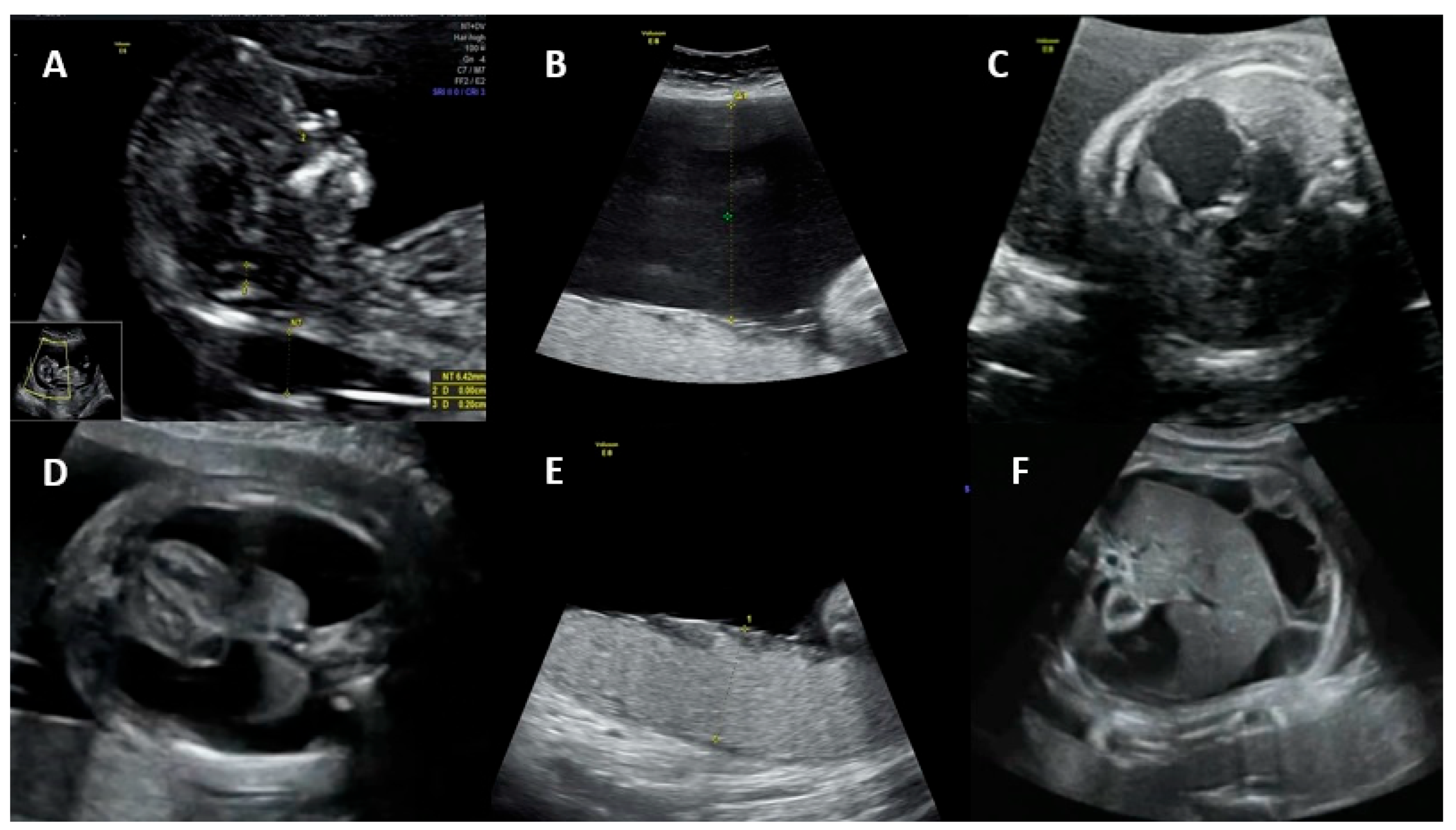 JPM | Free Full-Text | Parvovirus B19 Infection and Pregnancy