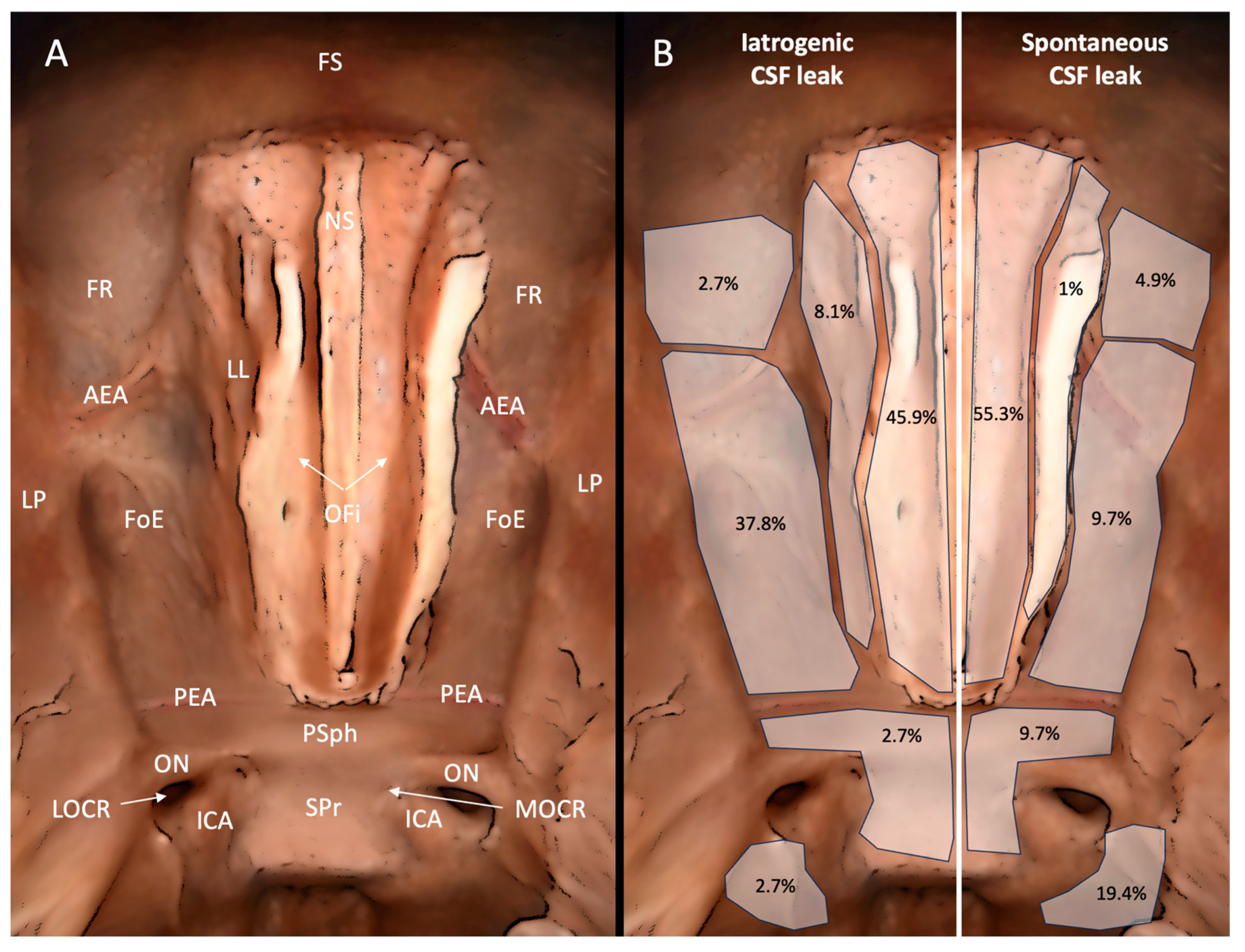 JPM Free Full Text Iatrogenic Cerebrospinal Fluid Leak in  