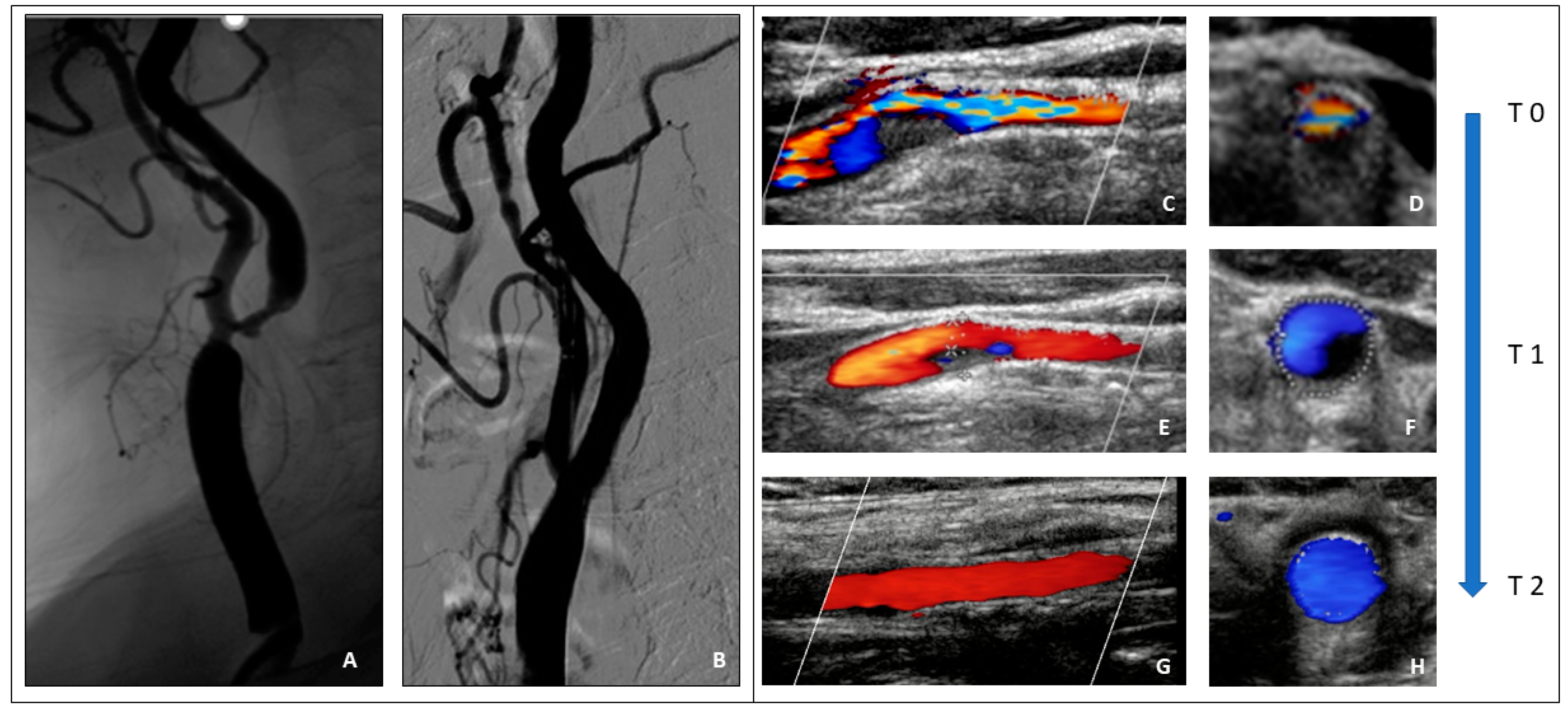 JPM | Free Full-Text | Uncommon Carotid Artery Stenting ...