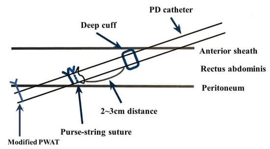 Two concentric purse-string sutures with 2-0 polypropylene on a MH... |  Download Scientific Diagram