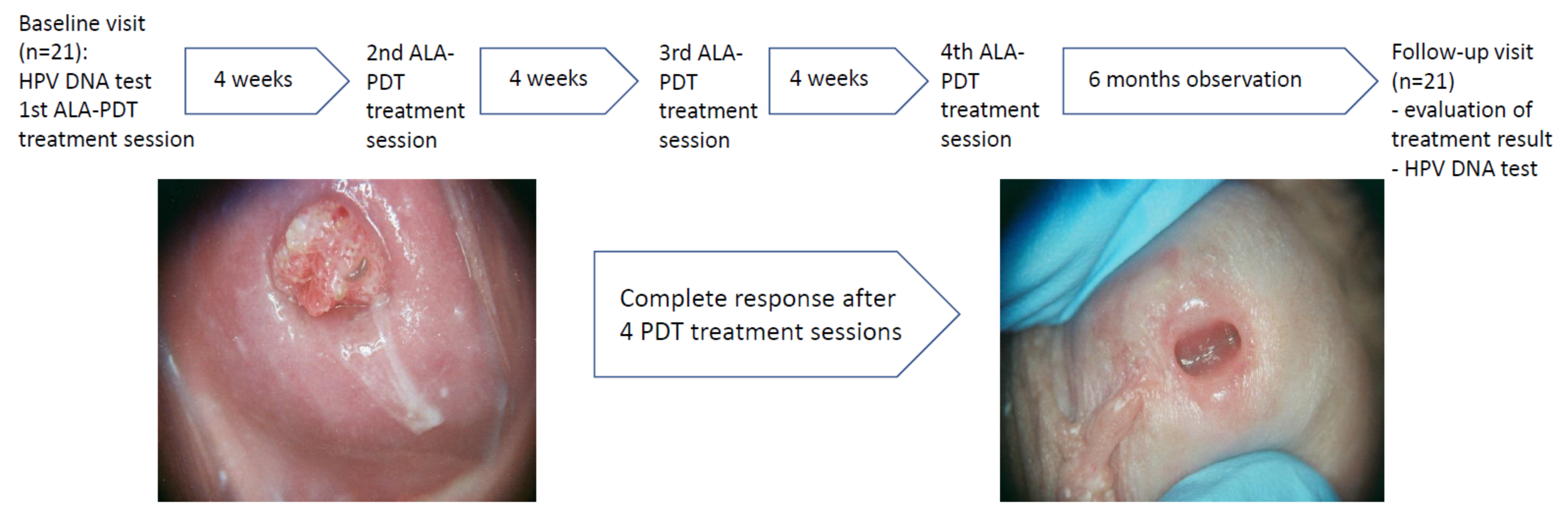 Life | Free Full-Text | Correlation of the ALA-PDT Treatment Efficacy and  the HPV Genotype Profile of Genital Warts after Cryotherapy Failure and  Podophyllotoxin Therapy in Male Patients