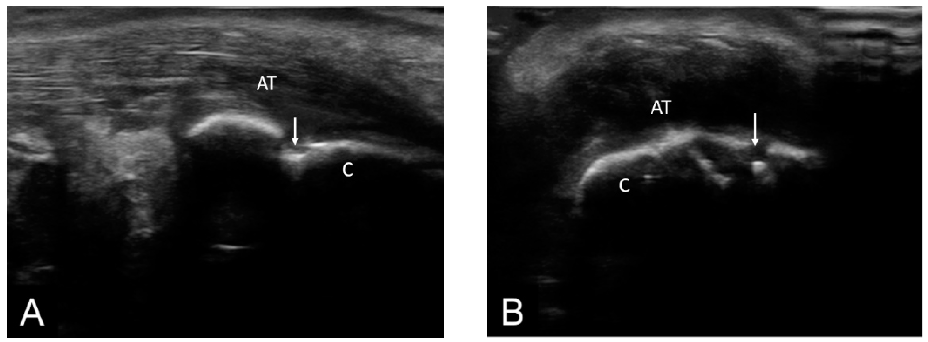 Life Free Full Text The Role Of Clinical And Ultrasound Enthesitis Scores In Ankylosing Spondylitis Html