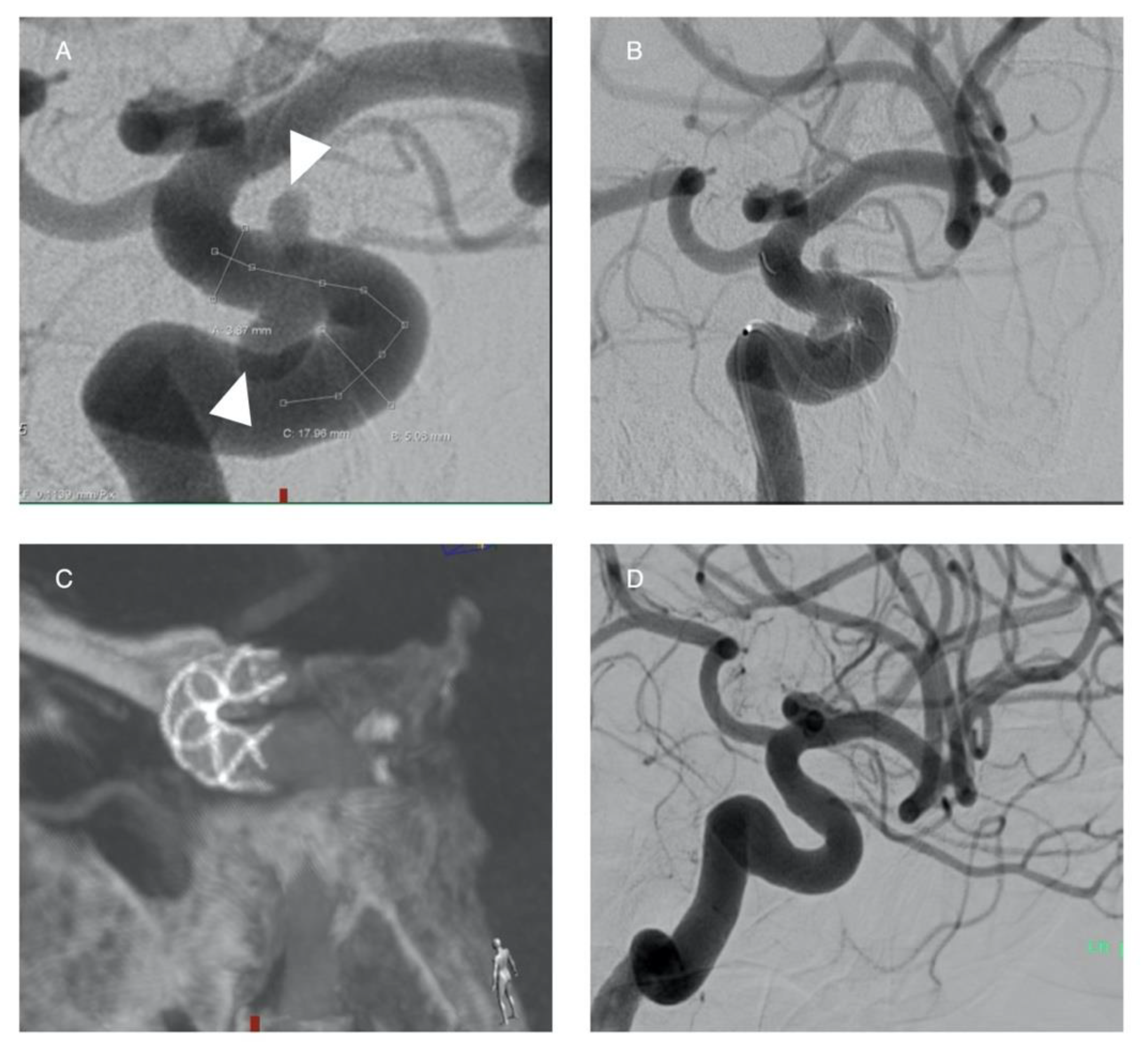 Life | Free Full-Text | Endovascular Treatment of Intracranial Aneurysms |  HTML