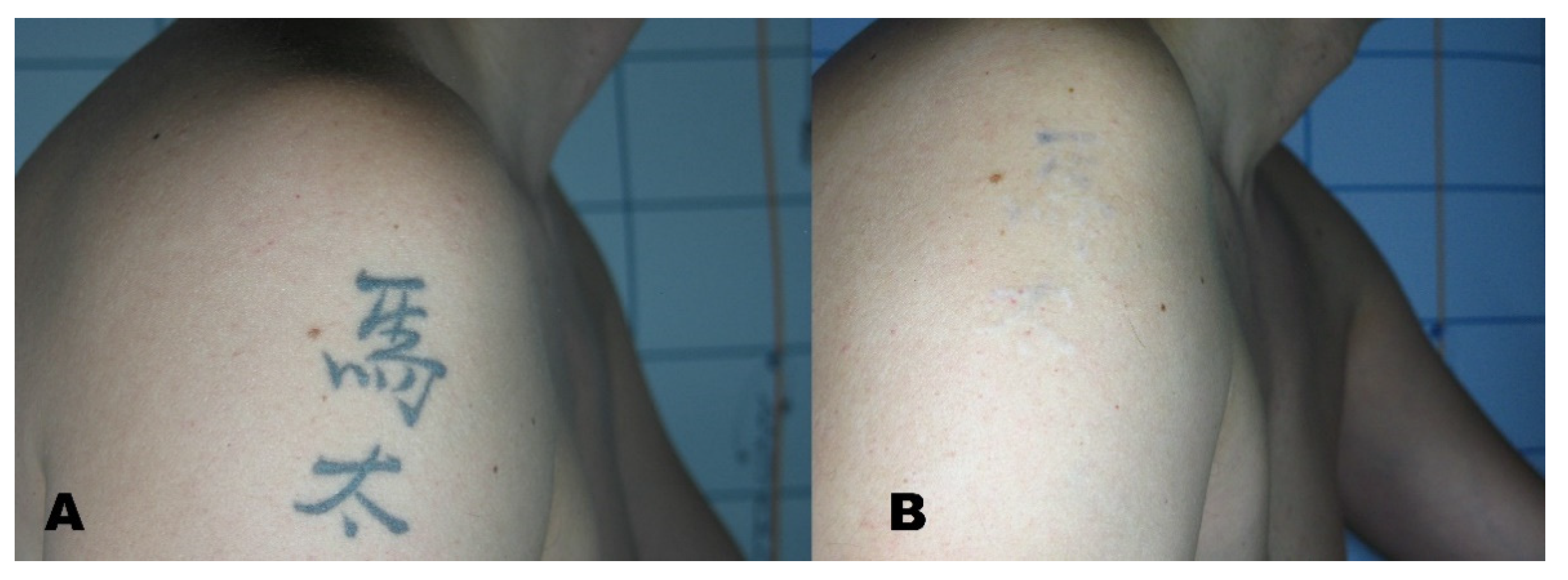 Laser Tattoo Removal  Conditions  Treatments  UCSF Health