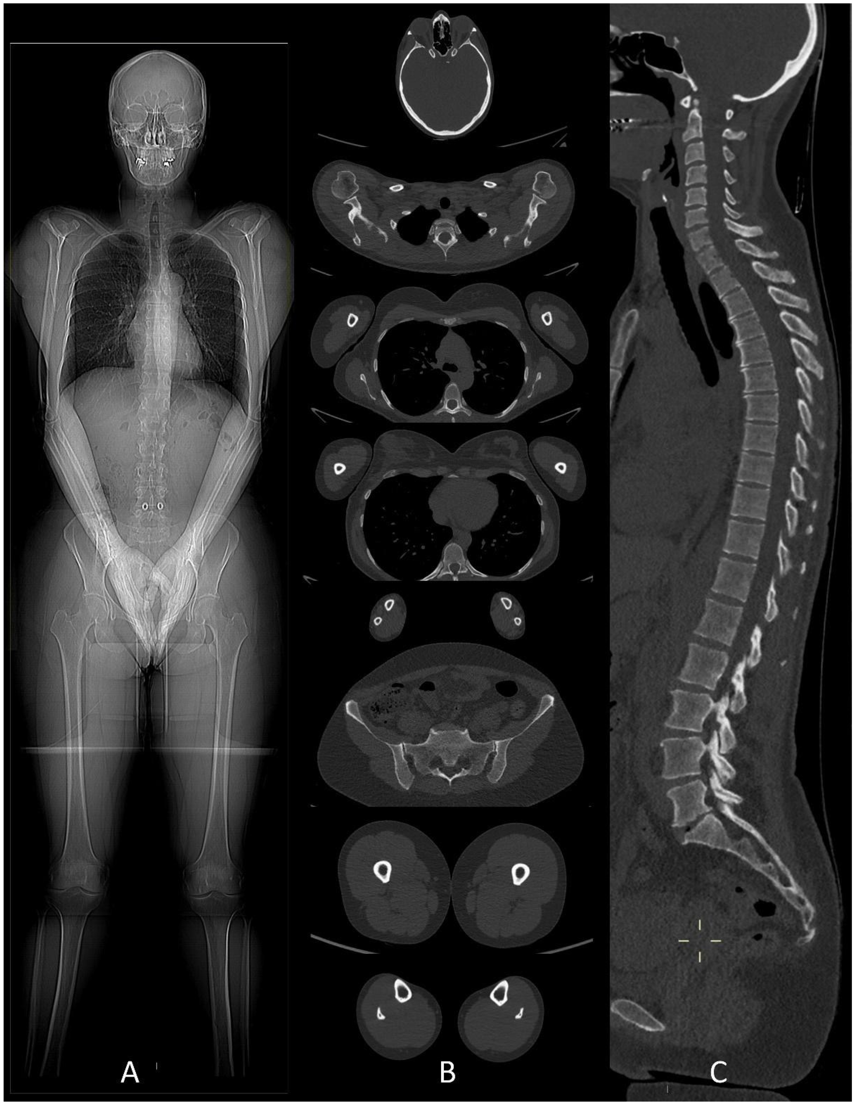 multiple myeloma x ray
