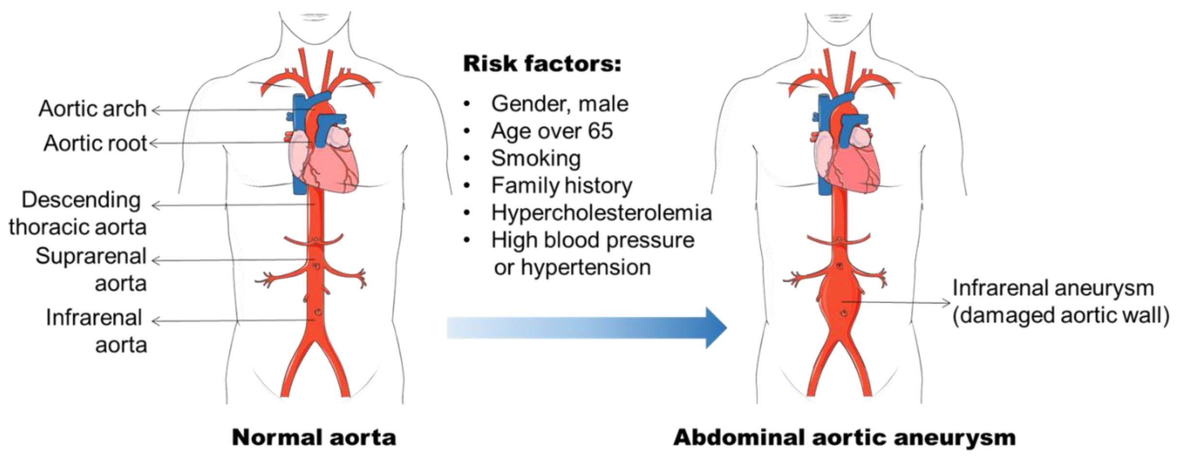 Life | Free Full-Text | Abdominal Aortic Aneurysm Formation with a Focus on  Vascular Smooth Muscle Cells