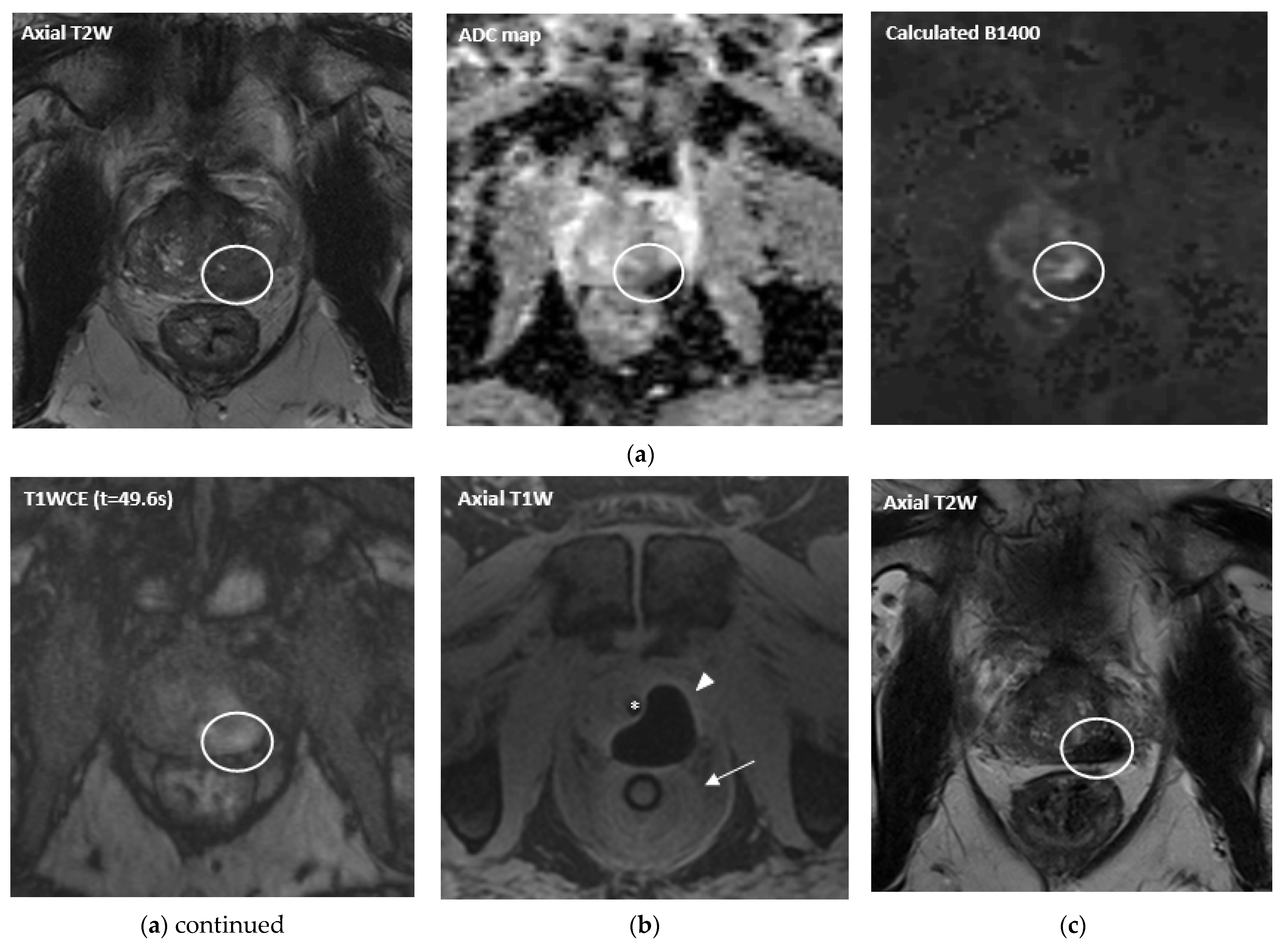 Sternal lesion depicted on screening breast MR images in a 34-year-old