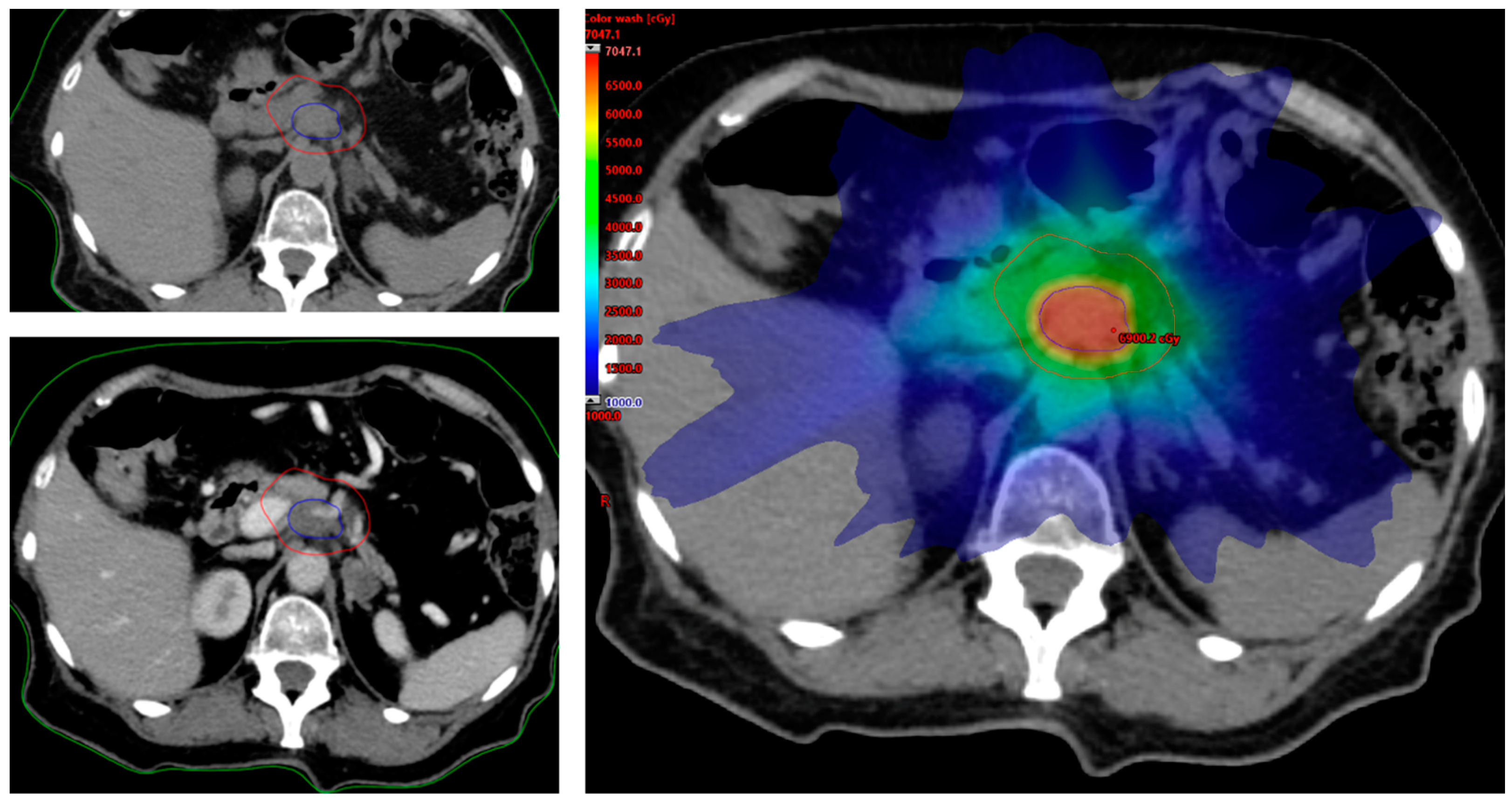 Life | Free Full-Text | Ablative Radiotherapy (ART) for Locally Advanced  Pancreatic Cancer (LAPC): Toward a New Paradigm?