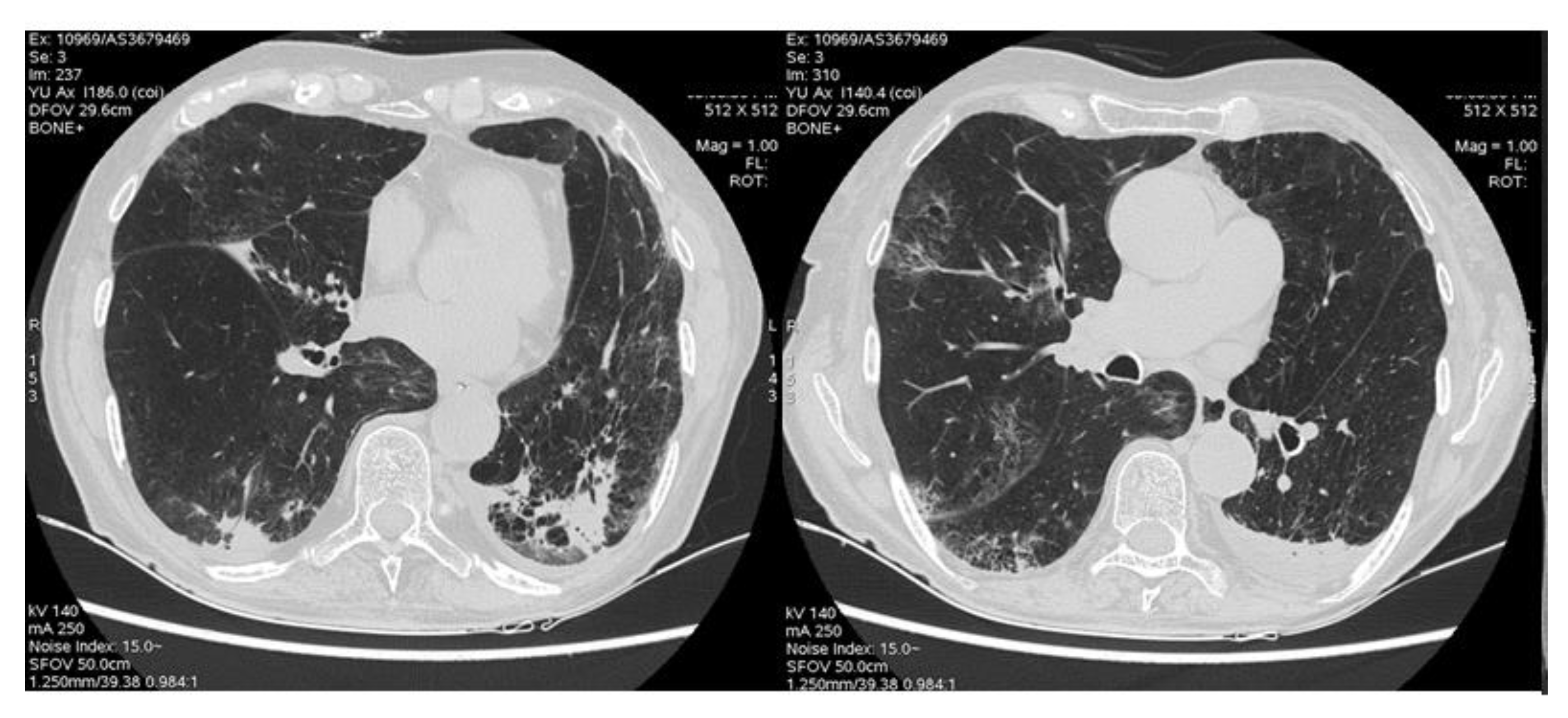 Life | Free Full-Text | Immune-Checkpoint-Inhibitor-Related Lung Toxicity:  A Multicentre Real-Life Retrospective Portrait from Six Italian Centres