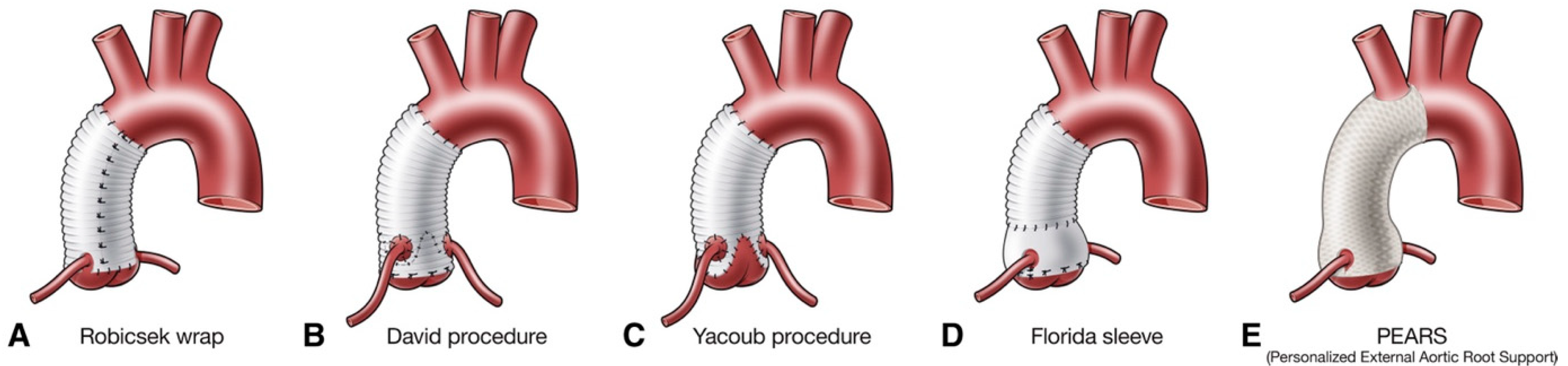 Life | Free Full-Text | Current Understanding Of Aortic Dissection