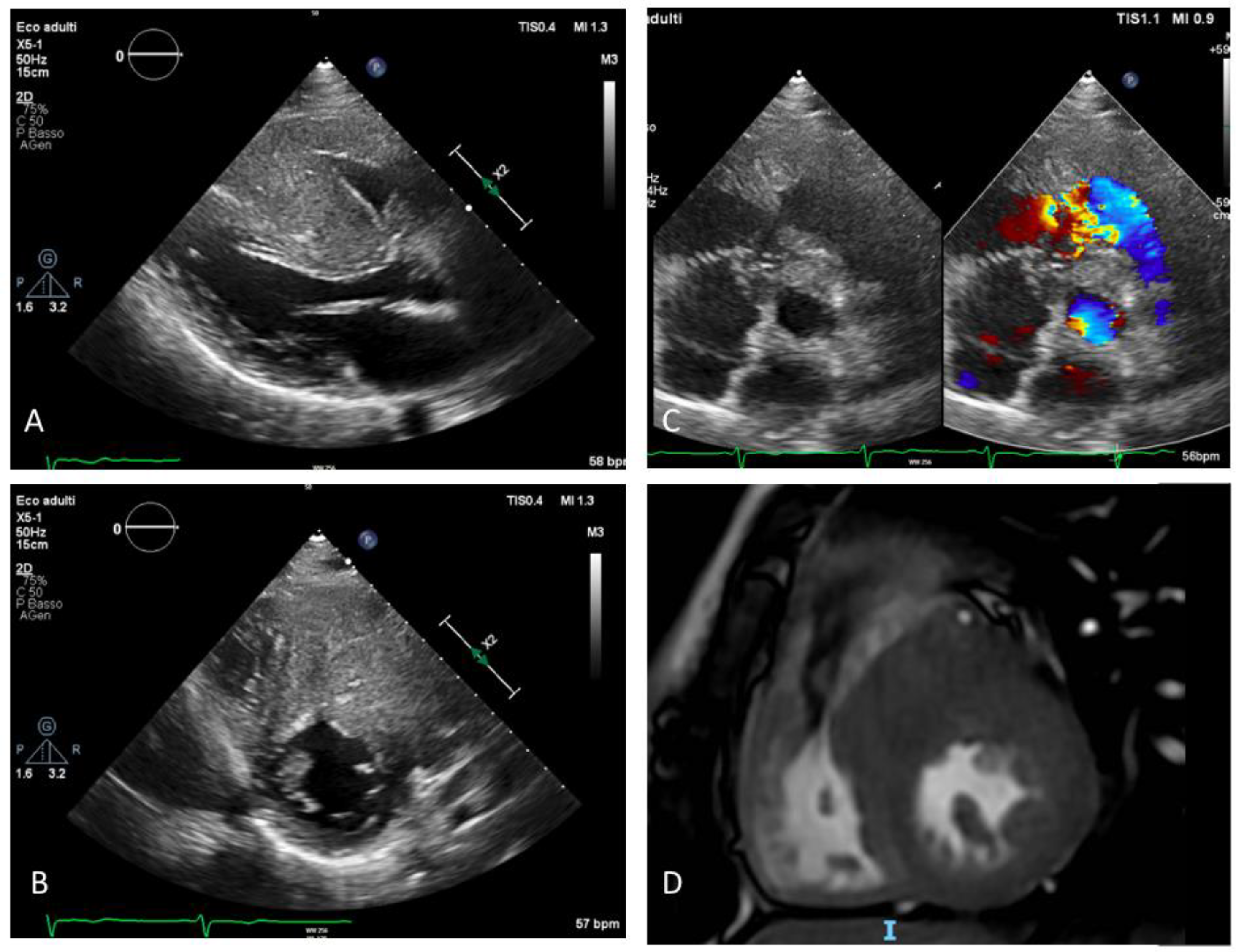 Life | Free Full-Text | Hypertrophic Cardiomyopathy with Biventricular  Involvement and Coronary Anomaly: A Case Report