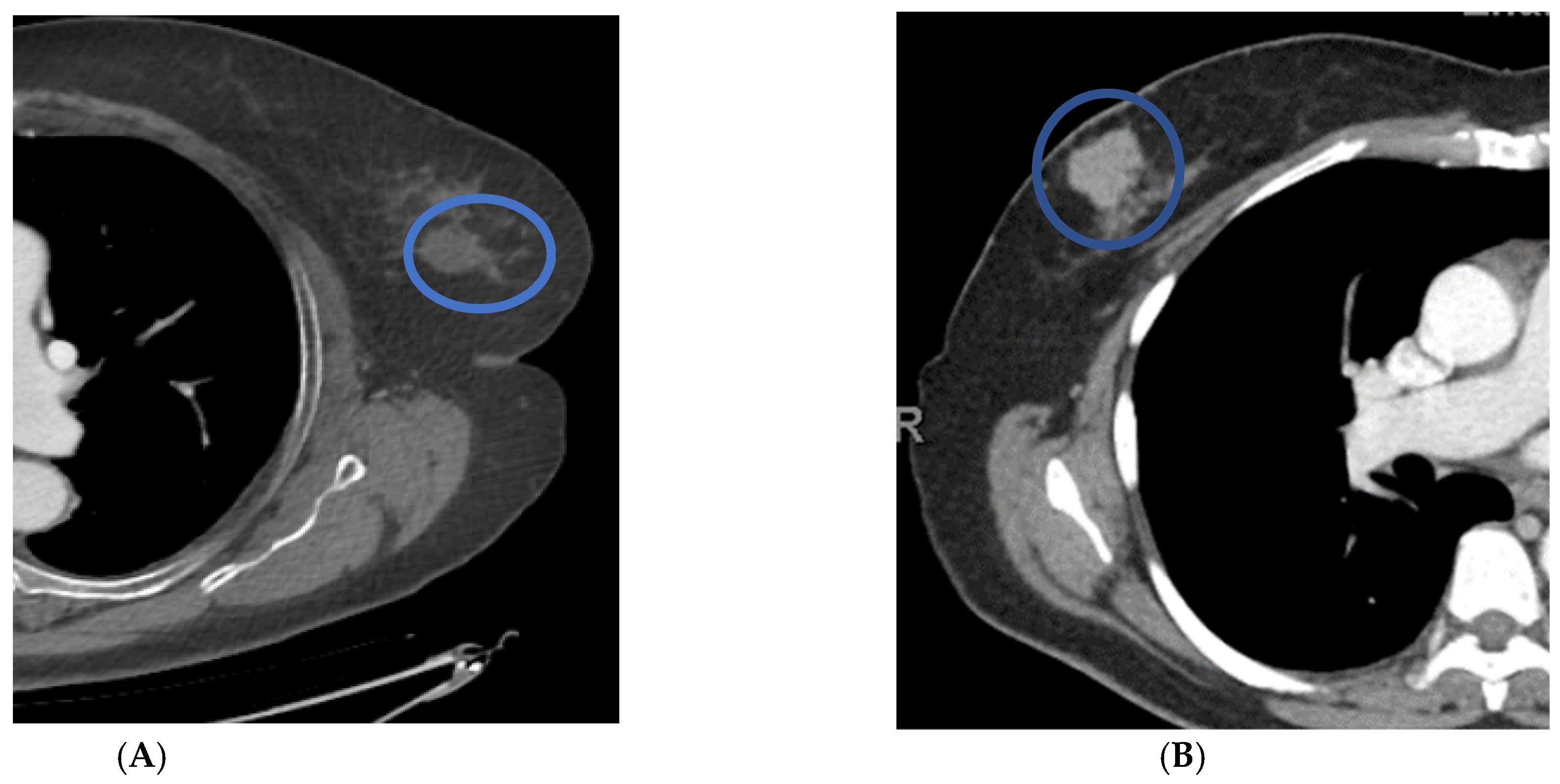 Life Free Full Text Chest Ct For Breast Cancer Diagnosis