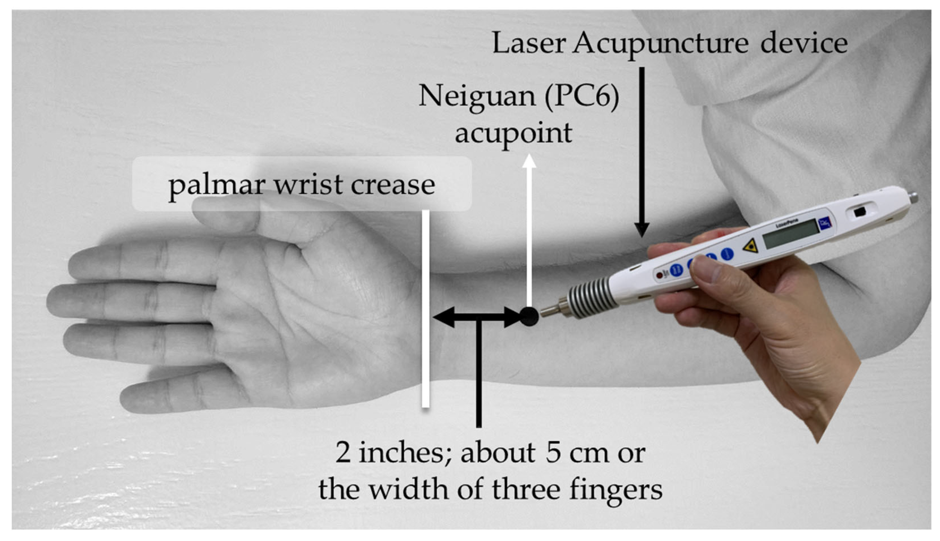 Life | Free Full-Text | The Dosage Effect of Laser Acupuncture at PC6  (Neiguan) on Heart Rate Variability: A Pilot Study