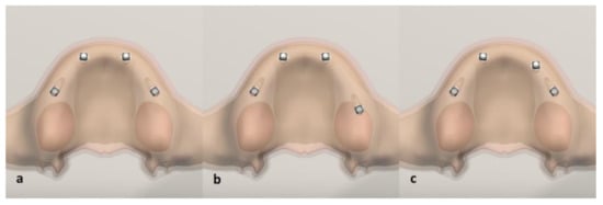 Biomechanical comparison of different prosthetic materials and posterior  implant angles in all-on-4 treatment concept by three-dimensional finite  element analysis