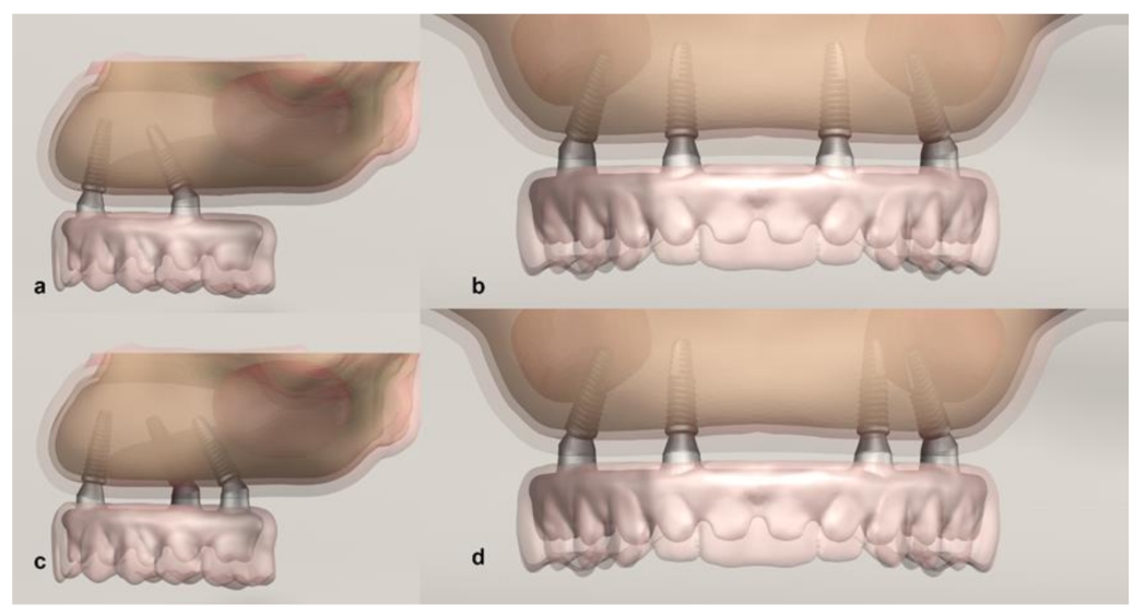 Biomechanical comparison of different prosthetic materials and posterior  implant angles in all-on-4 treatment concept by three-dimensional finite  element analysis