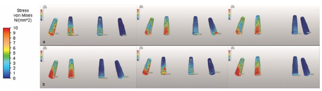 Biomechanical comparison of different prosthetic materials and posterior  implant angles in all-on-4 treatment concept by three-dimensional finite  element analysis