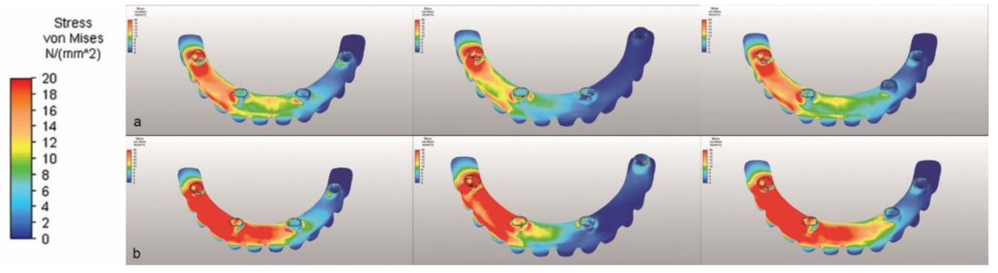 Biomechanical comparison of different prosthetic materials and posterior  implant angles in all-on-4 treatment concept by three-dimensional finite  element analysis