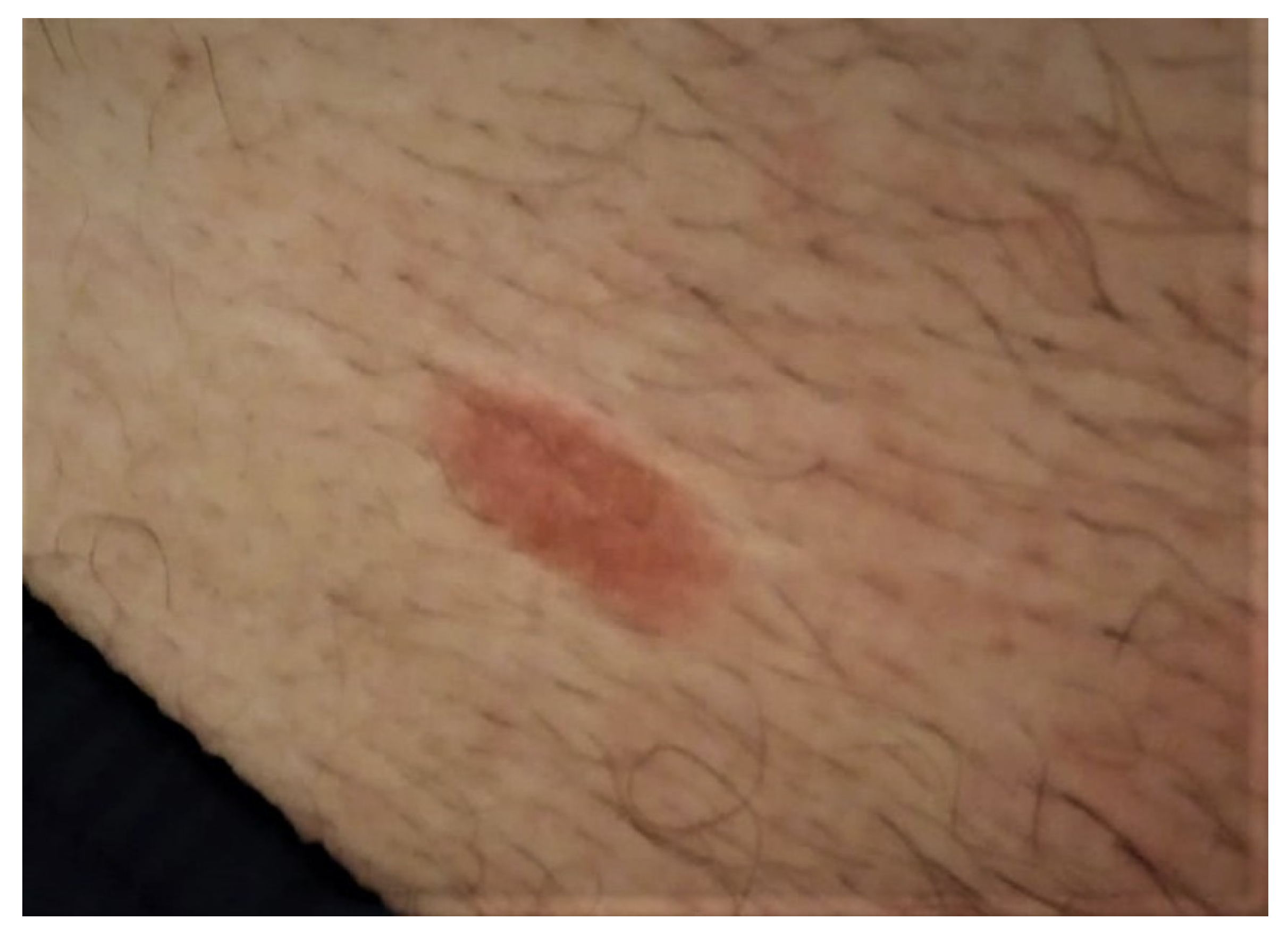 Dermatofibroma on leg in 37-year-old Black woman, demonstrating